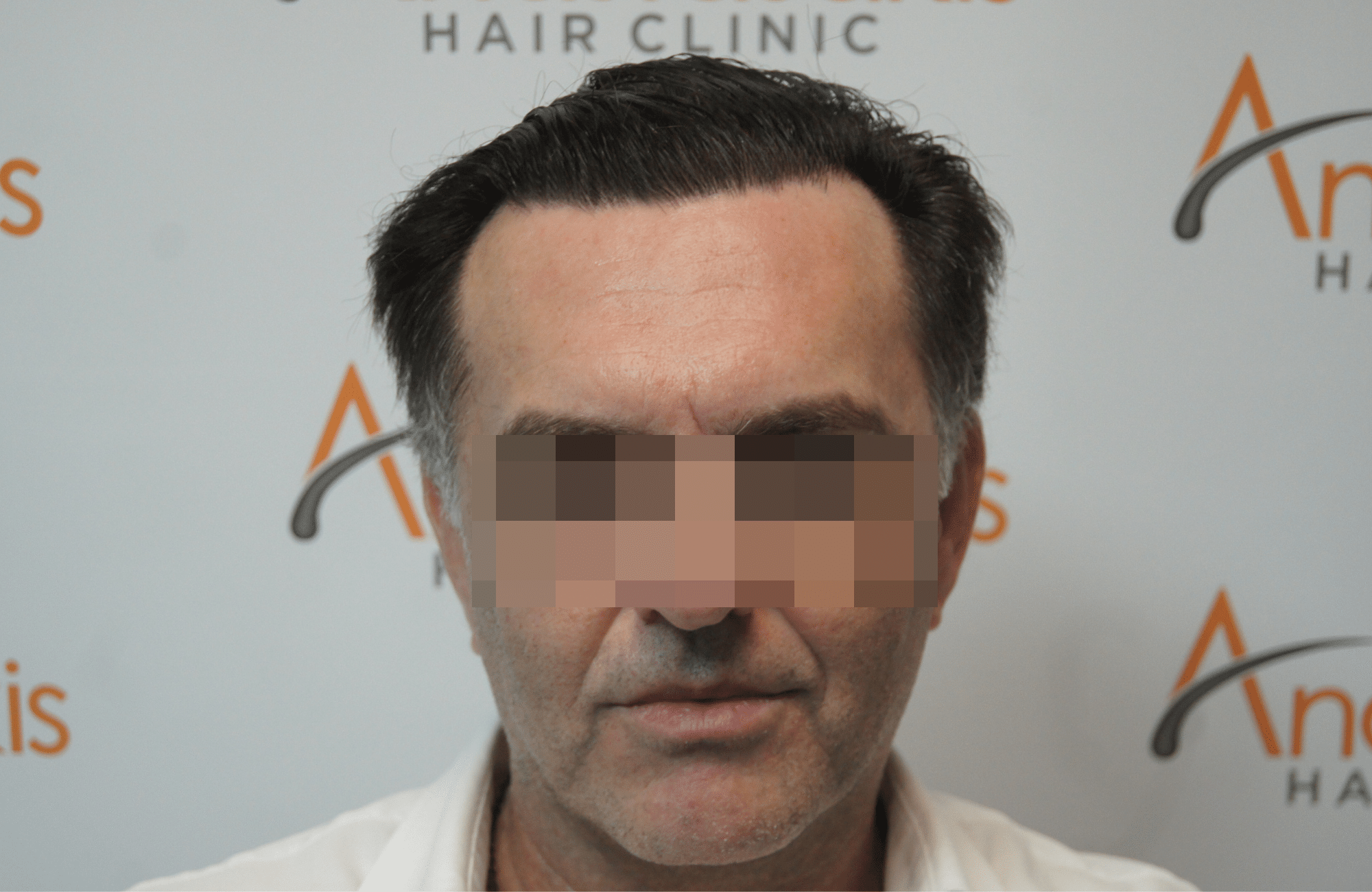 hair transplant resul with 3500 fus fue anastasakis hair clinic