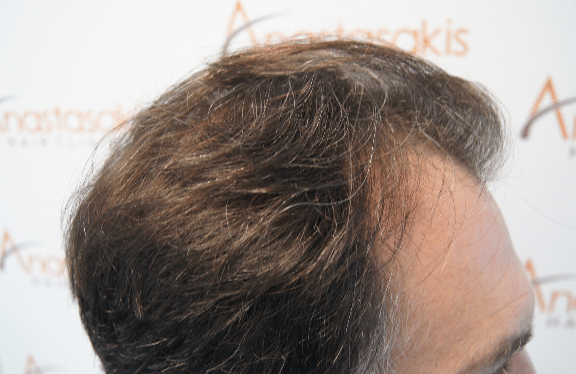 hair transplant resul with 3500 fus fue anastasakis hair clinic