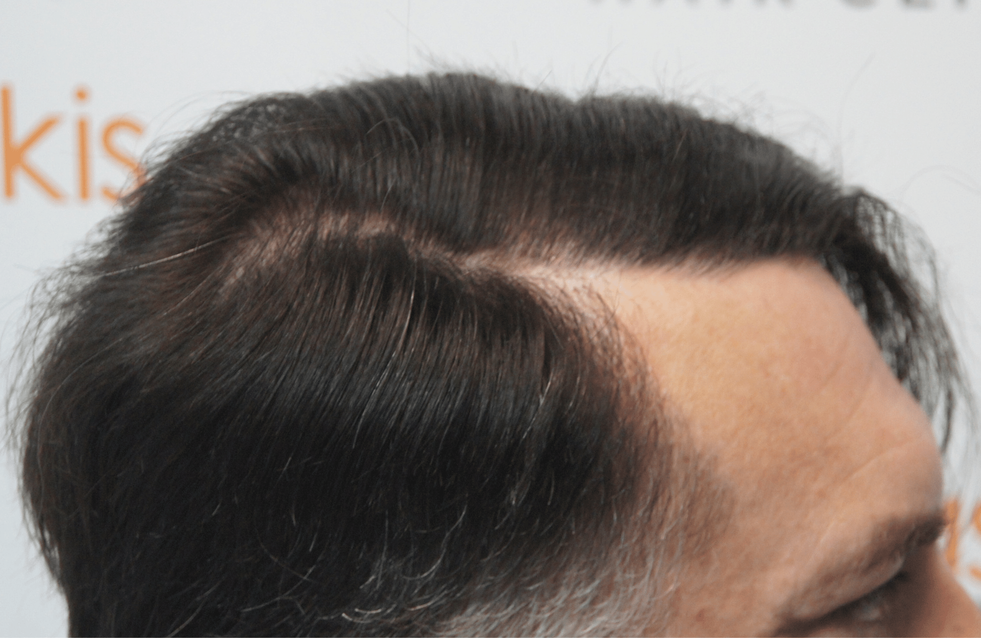 hair transplant resul with 3500 fus fue anastasakis hair clinic