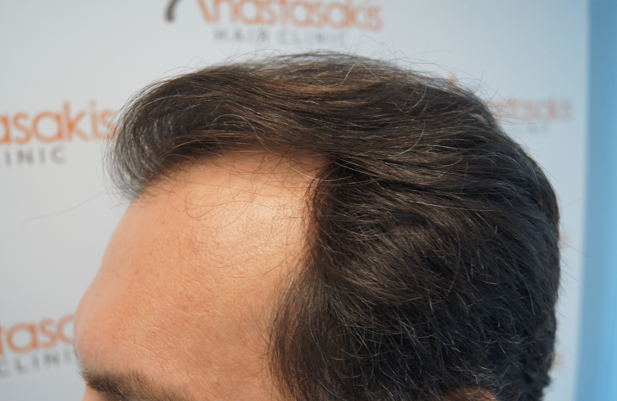 hair transplant resul with 3500 fus fue anastasakis hair clinic