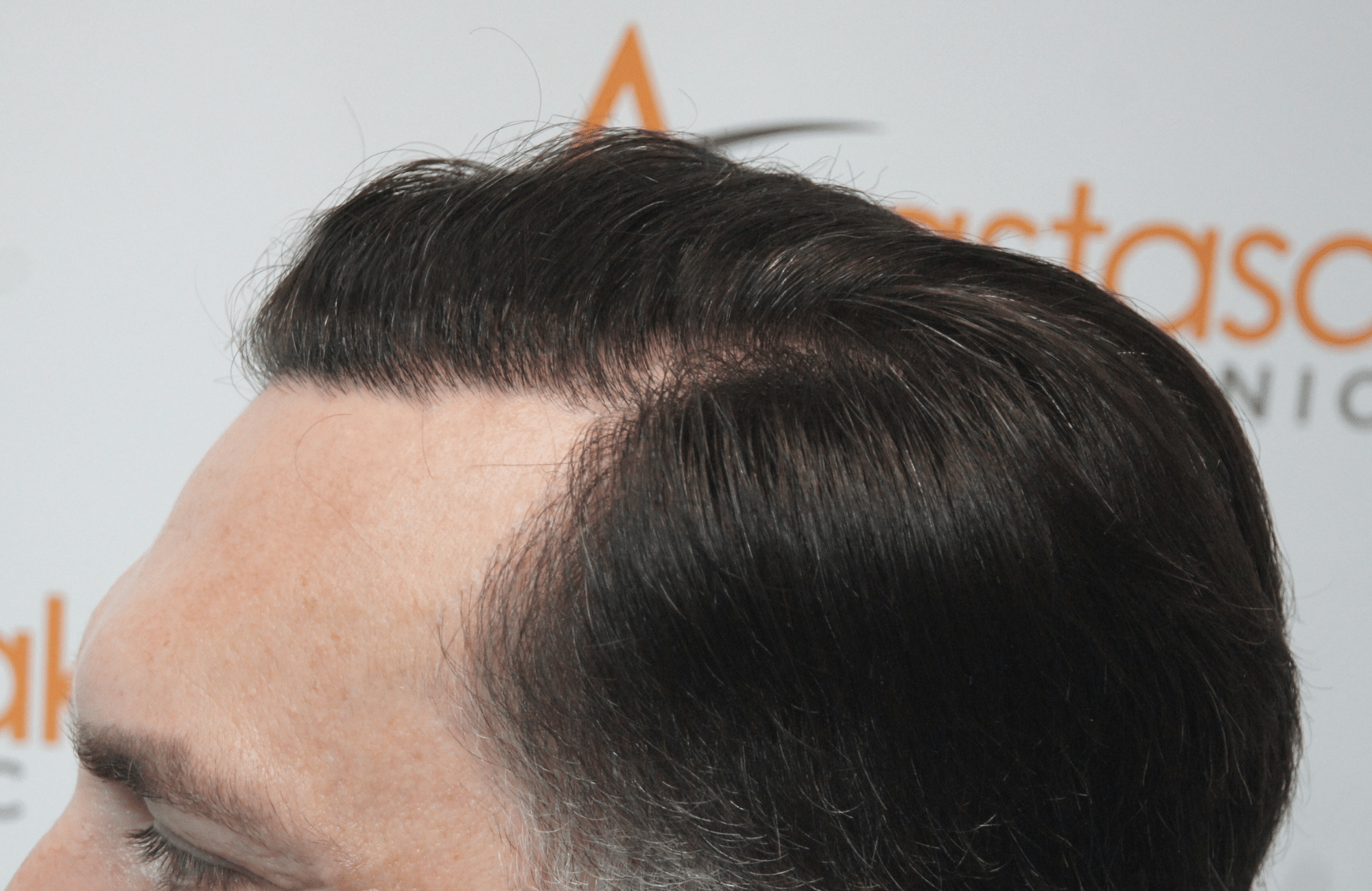 hair transplant resul with 3500 fus fue anastasakis hair clinic