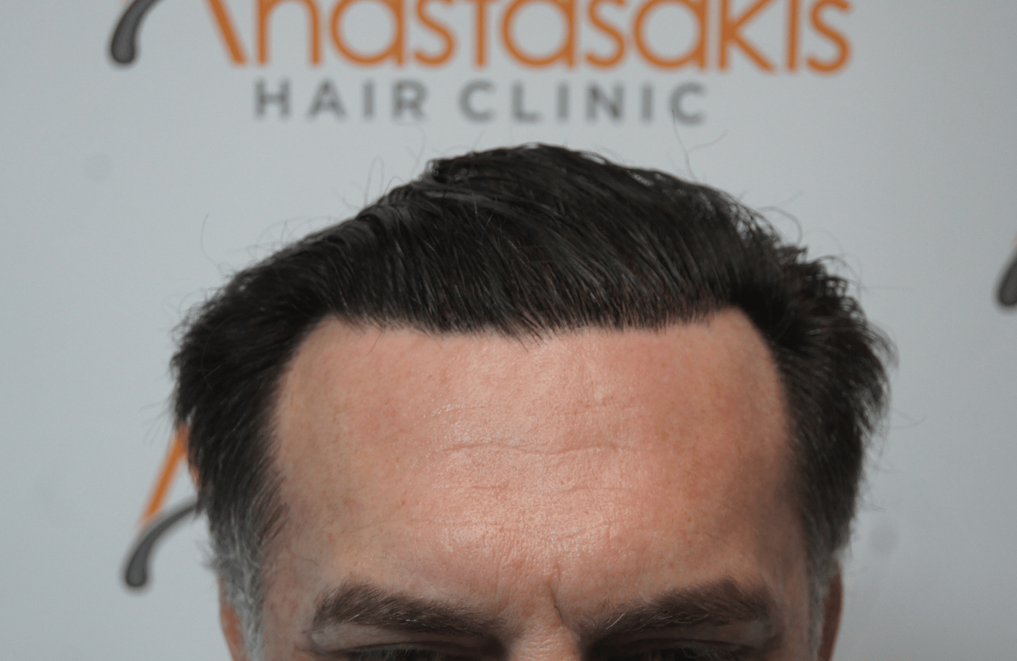 hair transplant resul with 3500 fus fue anastasakis hair clinic
