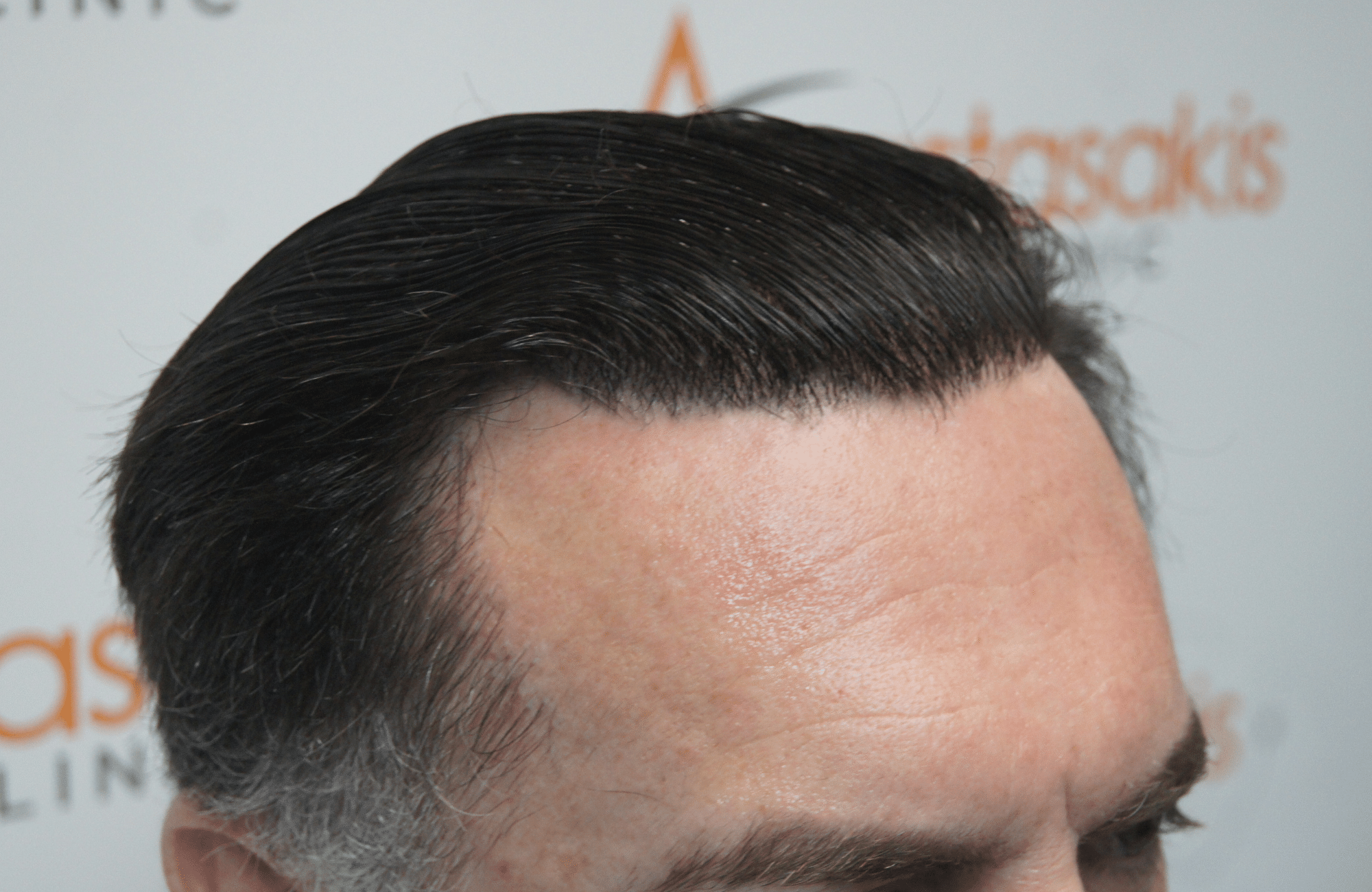 hair transplant resul with 3500 fus fue anastasakis hair clinic