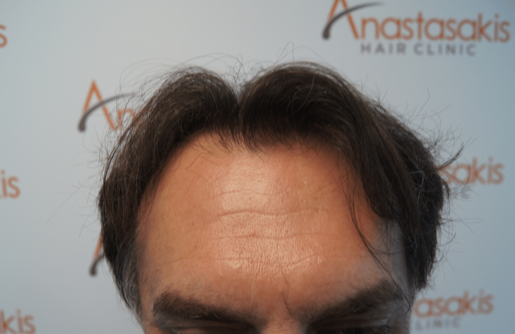 hair transplant resul with 3500 fus fue anastasakis hair clinic