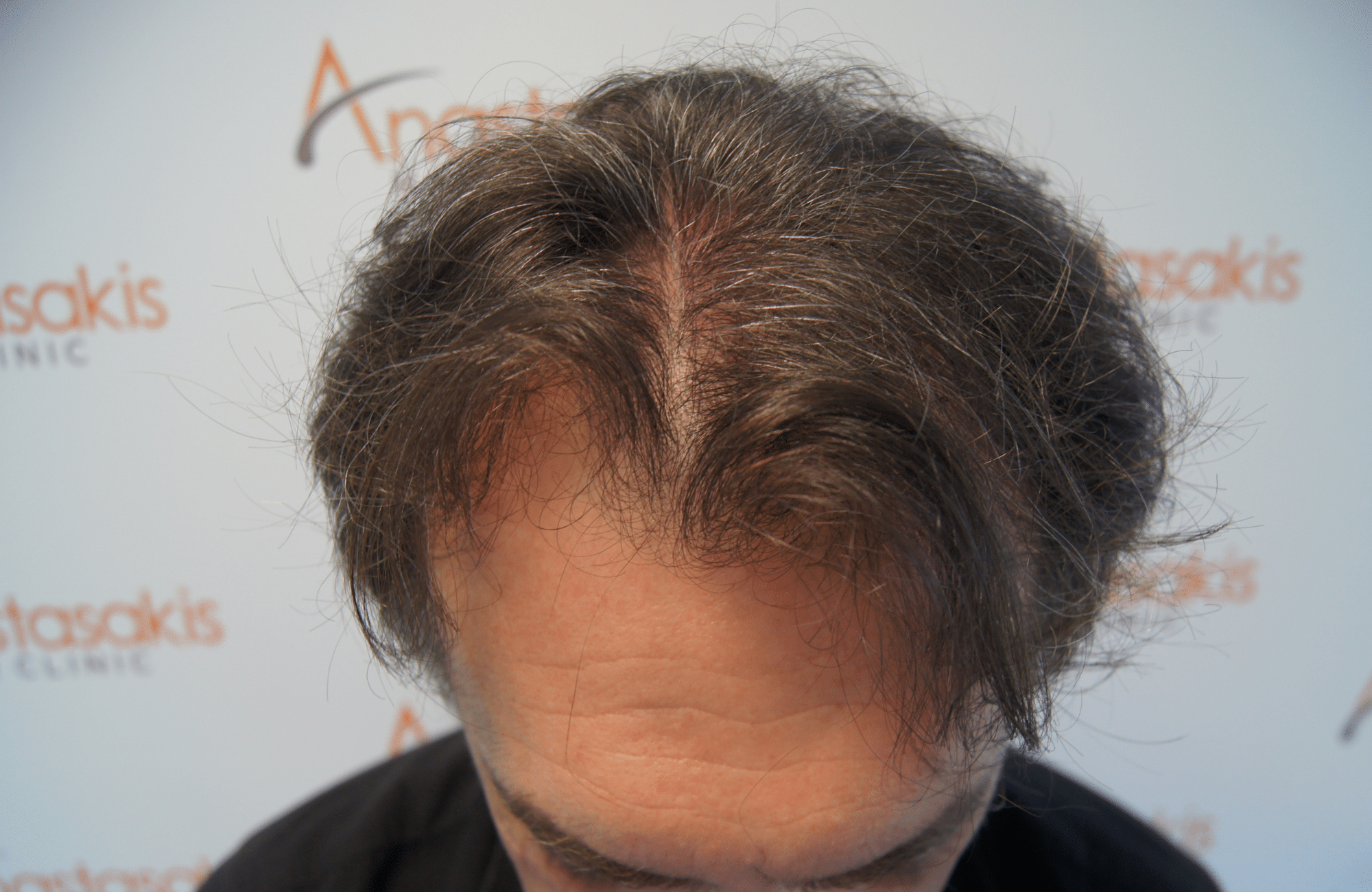 hair transplant resul with 3500 fus fue anastasakis hair clinic