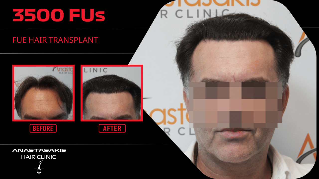hair transplant resul with 3500 fus fue anastasakis hair clinic
