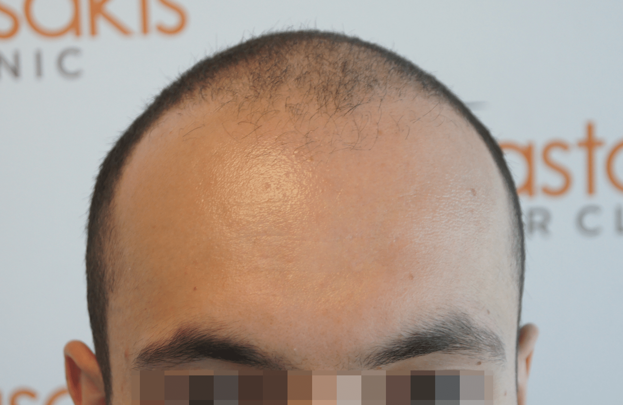 hair transplant resul with 5000 2nd stage fus fue anastasakis hair clinic