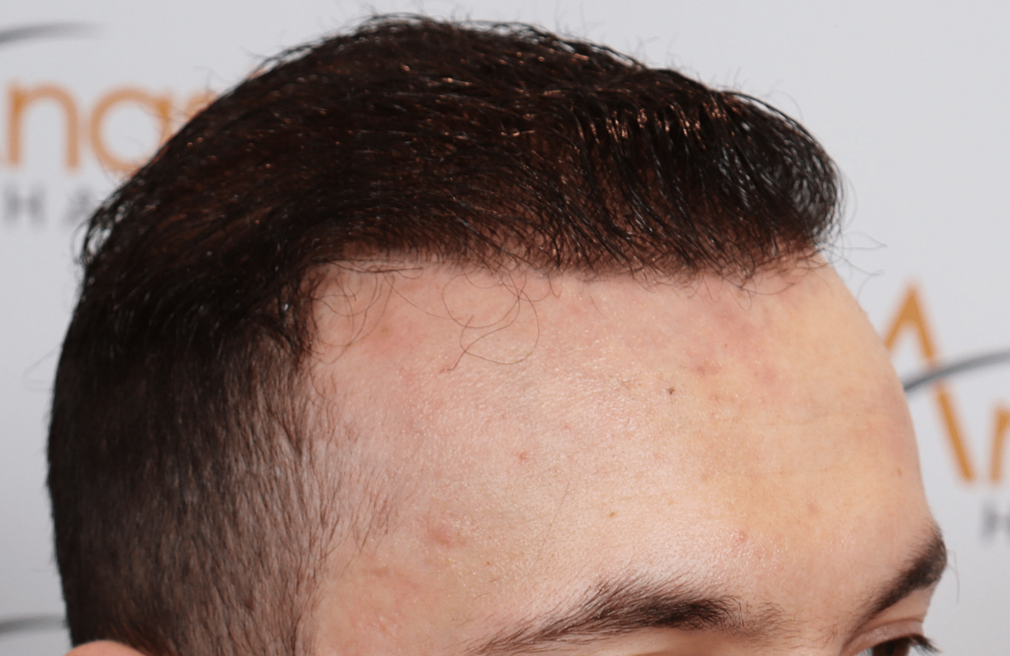 hair transplant resul with 5000 2nd stage fus fue anastasakis hair clinic