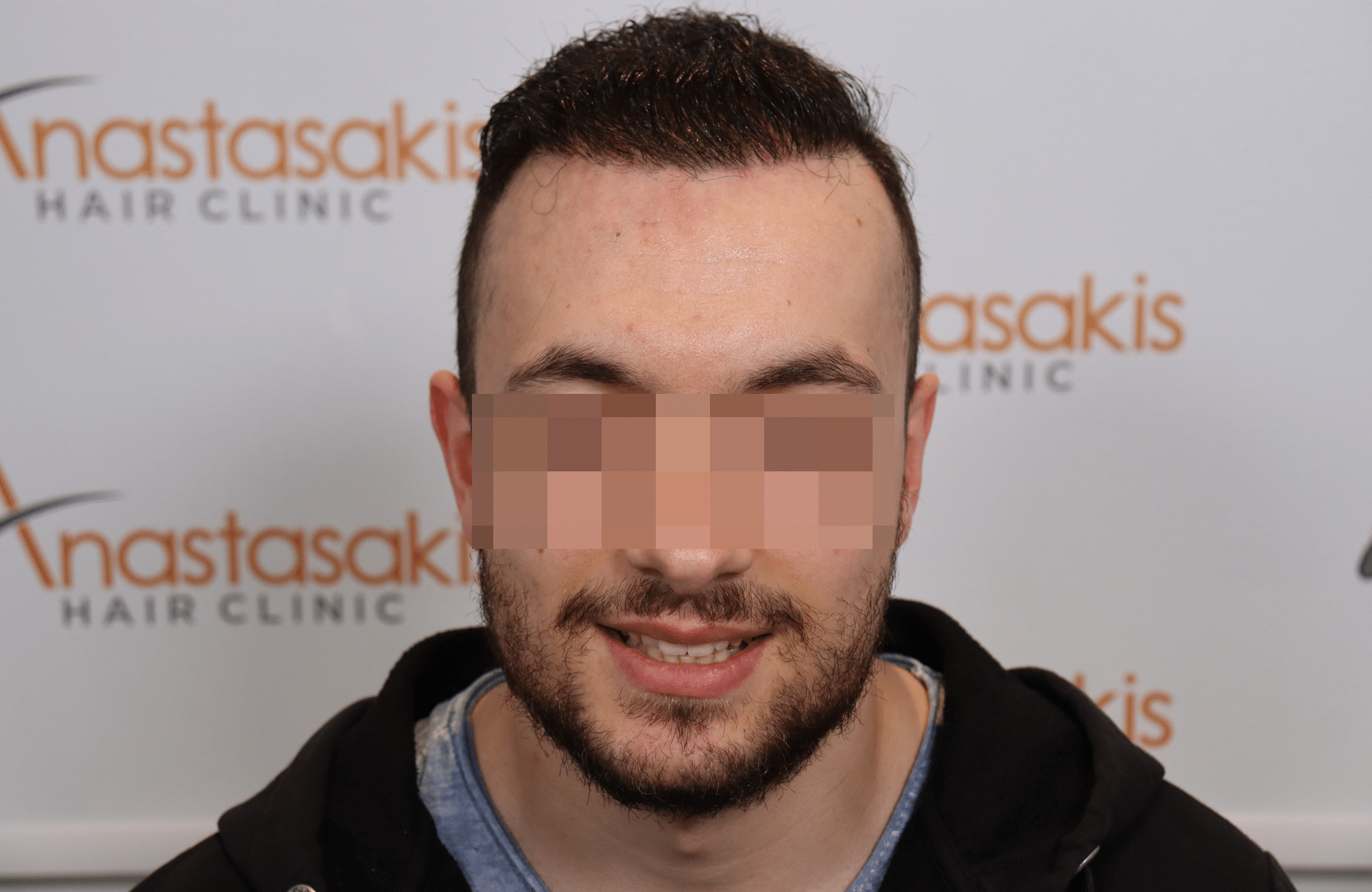 hair transplant resul with 5000 2nd stage fus fue anastasakis hair clinic