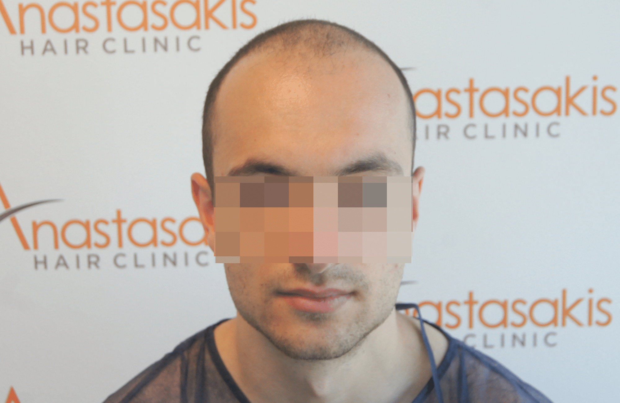 hair transplant resul with 5000 2nd stage fus fue anastasakis hair clinic