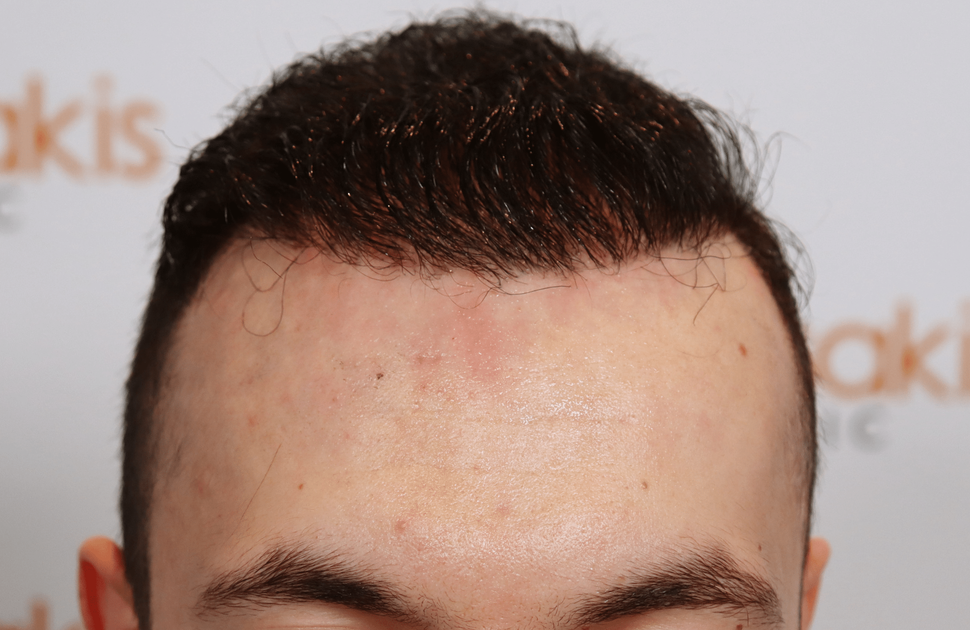 hair transplant resul with 5000 2nd stage fus fue anastasakis hair clinic