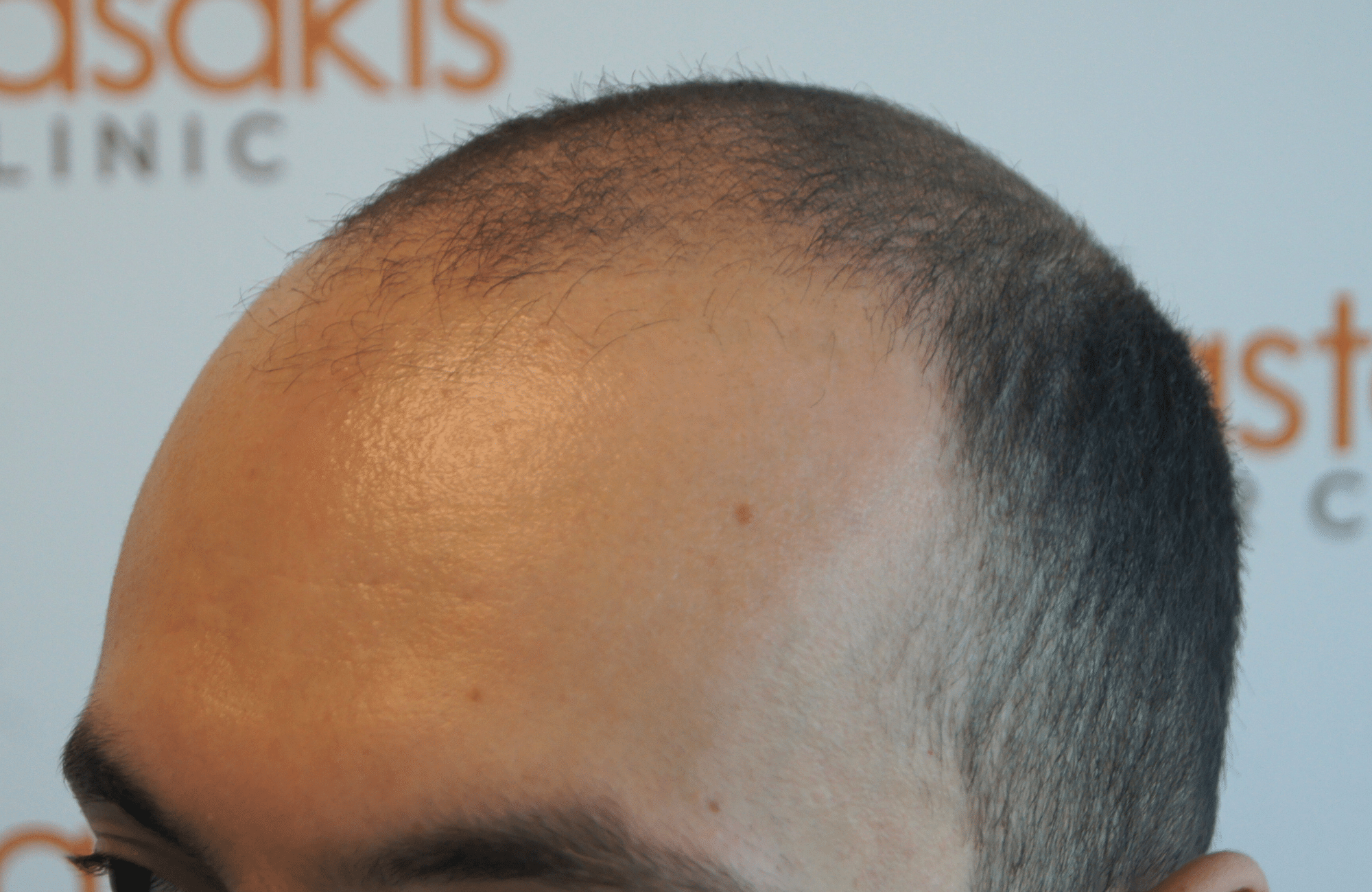 hair transplant resul with 5000 2nd stage fus fue anastasakis hair clinic