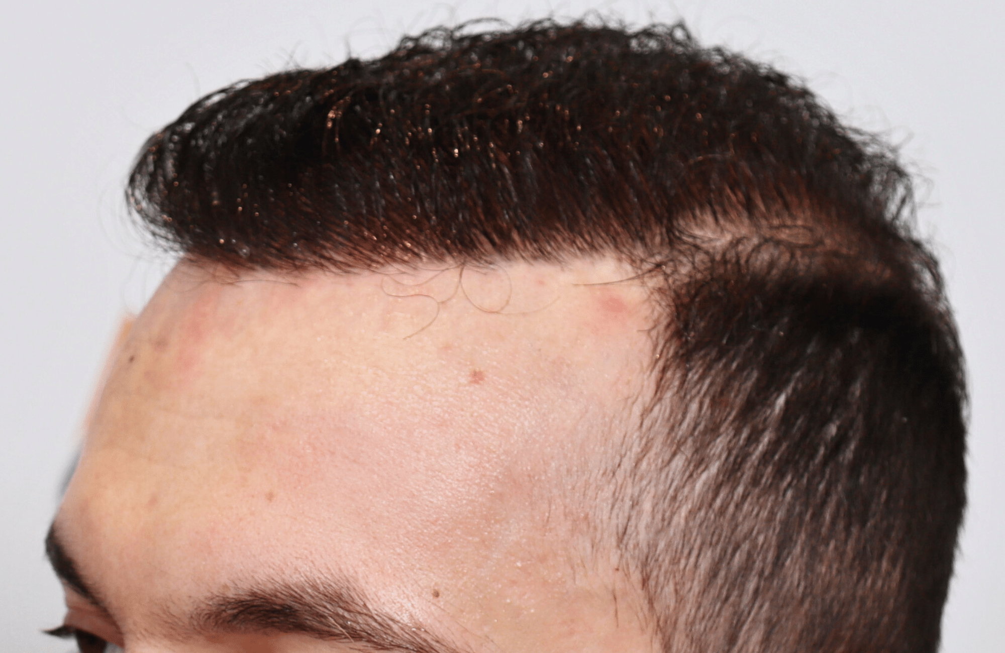 hair transplant resul with 5000 2nd stage fus fue anastasakis hair clinic