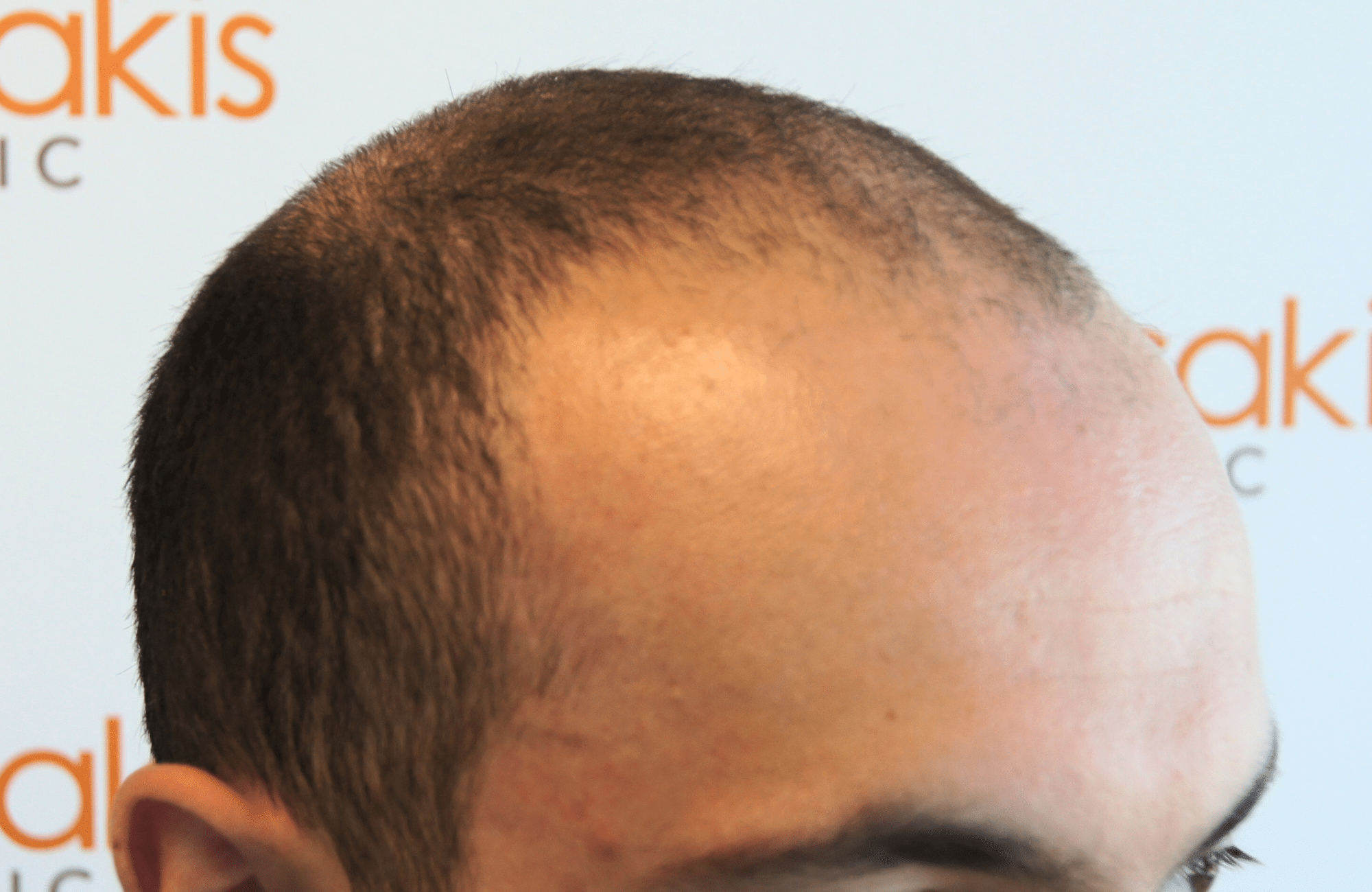 hair transplant resul with 5000 2nd stage fus fue anastasakis hair clinic