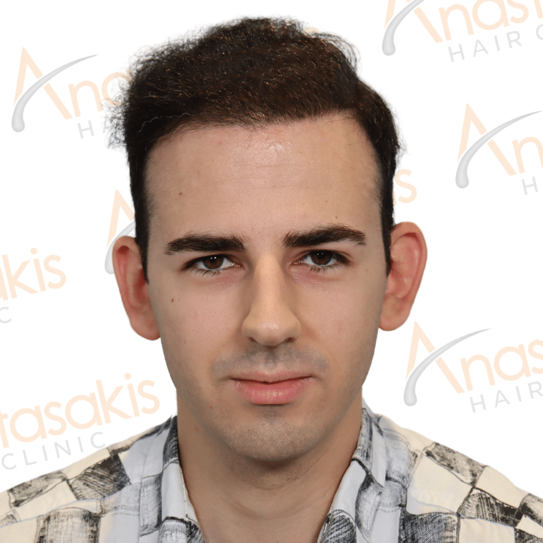 best hair transplant result with 3000 fus male fue anastasakis hair clinic