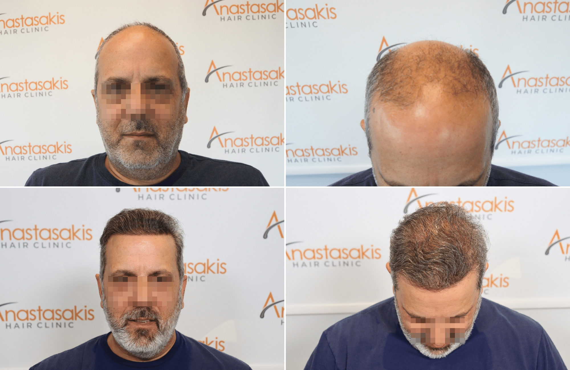 https://www.anastasakishairclinic.gr/portfolio/apotelesma-metamosxefsis-mallion-anastasakis-hair-clinic-508/