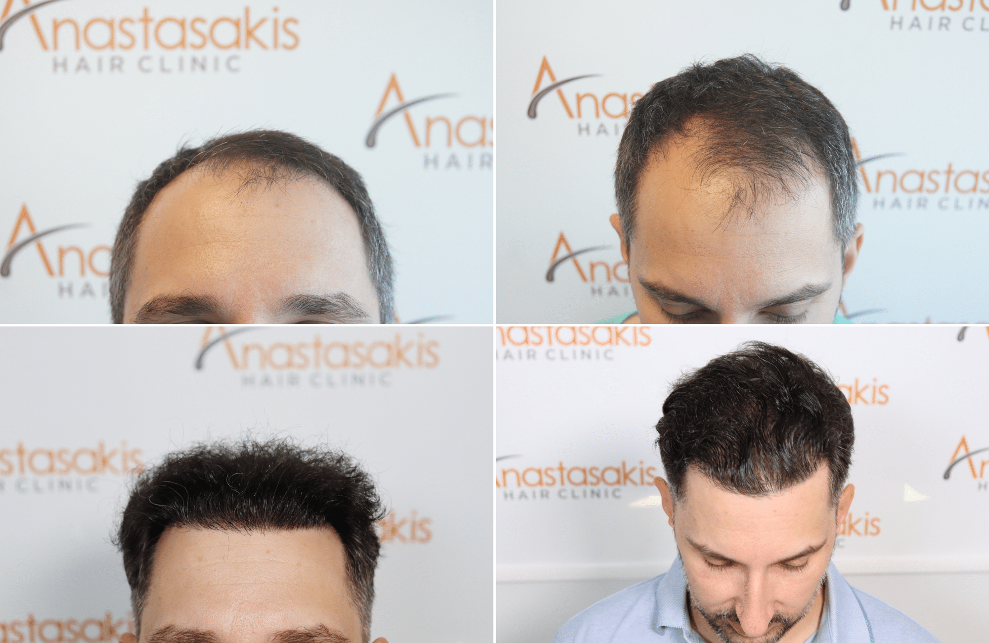 https://www.anastasakishairclinic.gr/portfolio/apotelesma-metamosxefsis-mallion-anastasakis-hair-clinic-513/