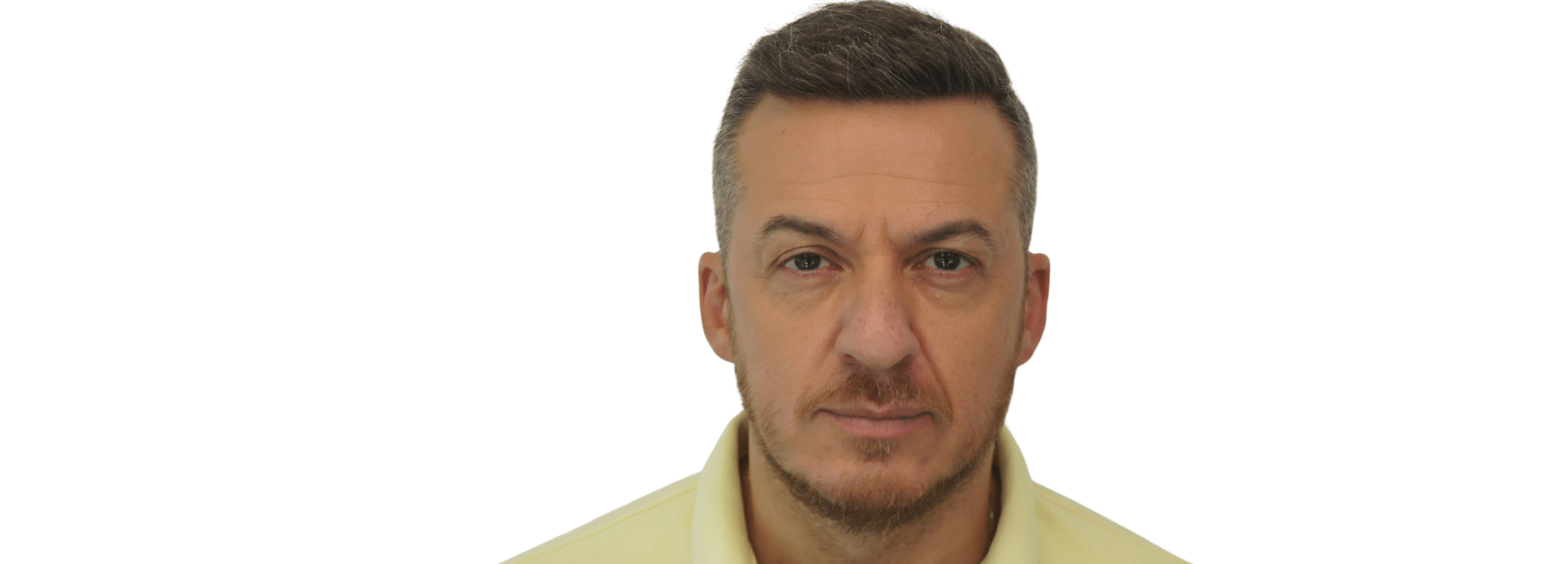Μεταμόσχευση Μαλλιών FUE