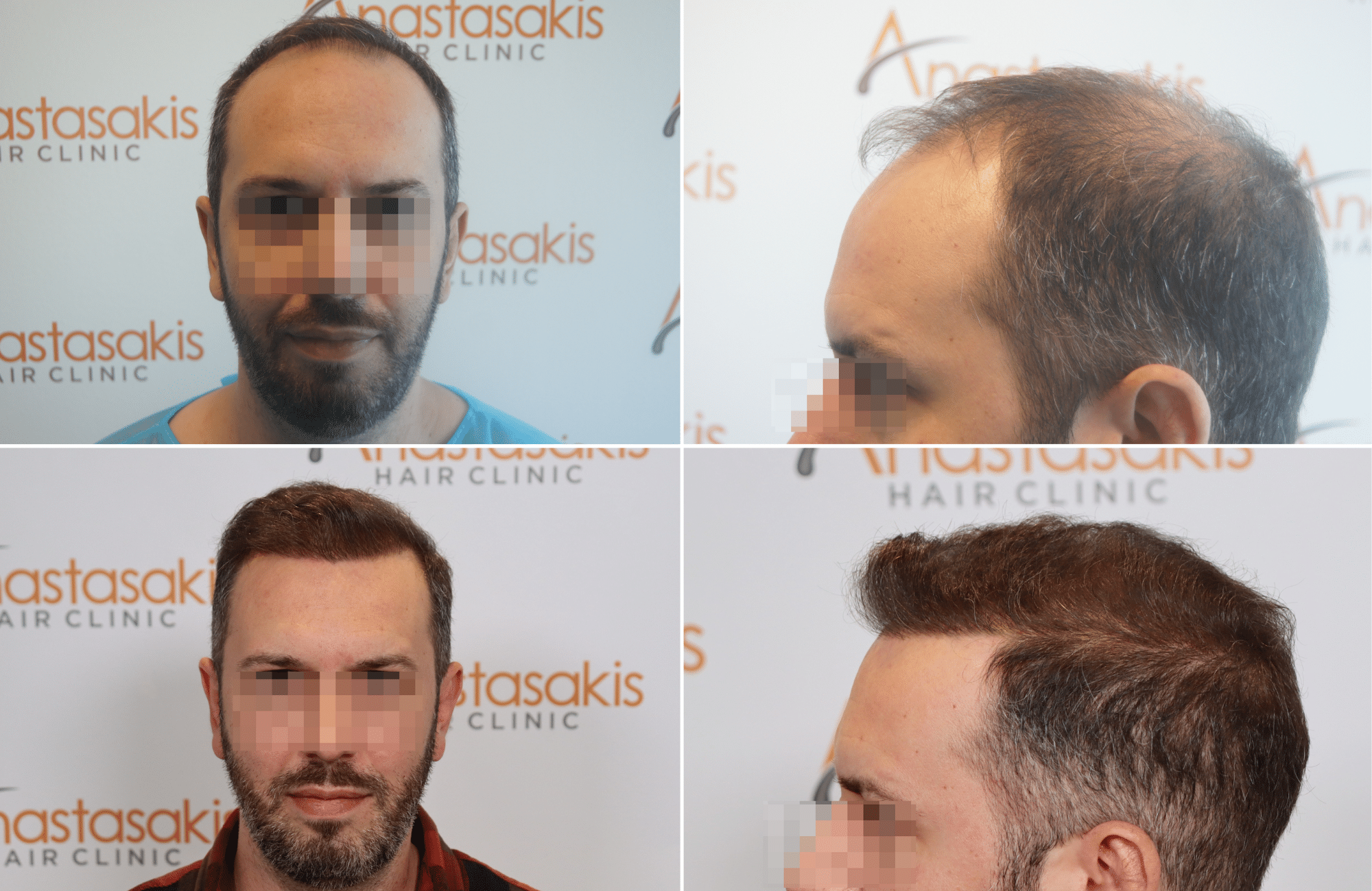 https://www.anastasakishairclinic.gr/portfolio/apotelesma-metamosxefsis-mallion-anastasakis-hair-clinic-501/