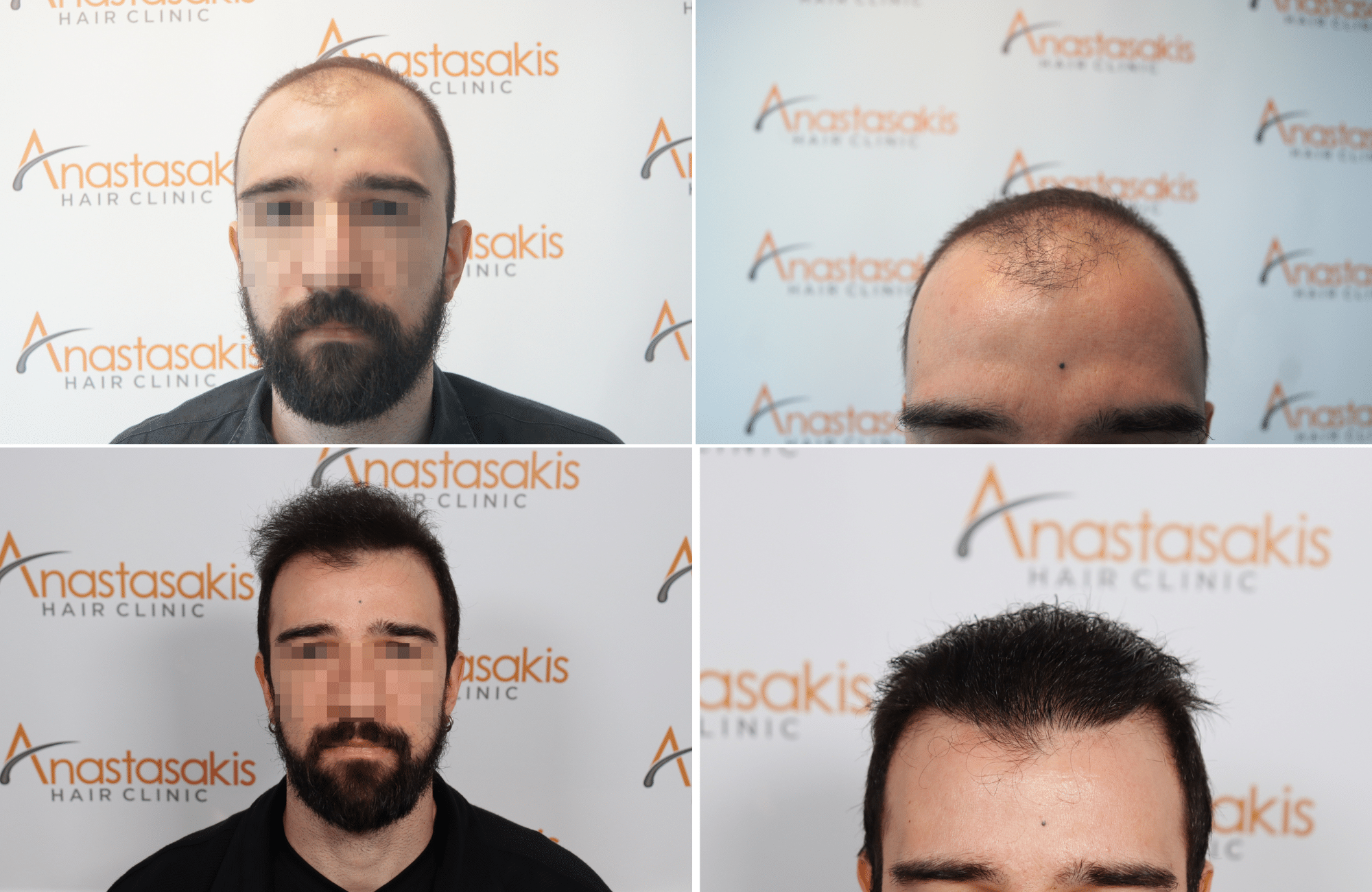 https://www.anastasakishairclinic.gr/portfolio/apotelesma-metamosxefsis-mallion-anastasakis-hair-clinic-507/