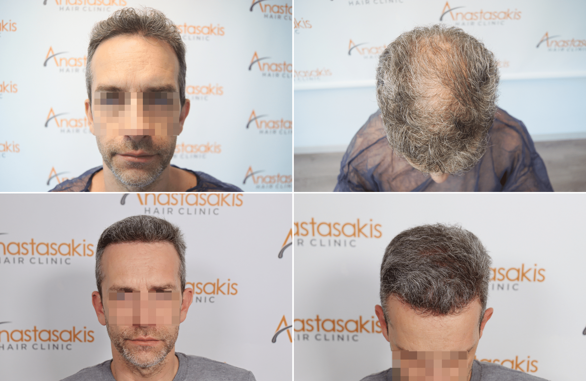 https://www.anastasakishairclinic.gr/portfolio/apotelesma-metamosxefsis-mallion-anastasakis-hair-clinic-510/
