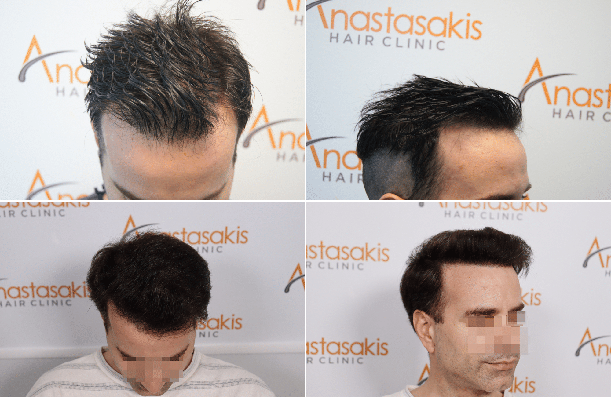 https://www.anastasakishairclinic.gr/portfolio/apotelesma-metamosxefsis-mallion-anastasakis-hair-clinic-511/