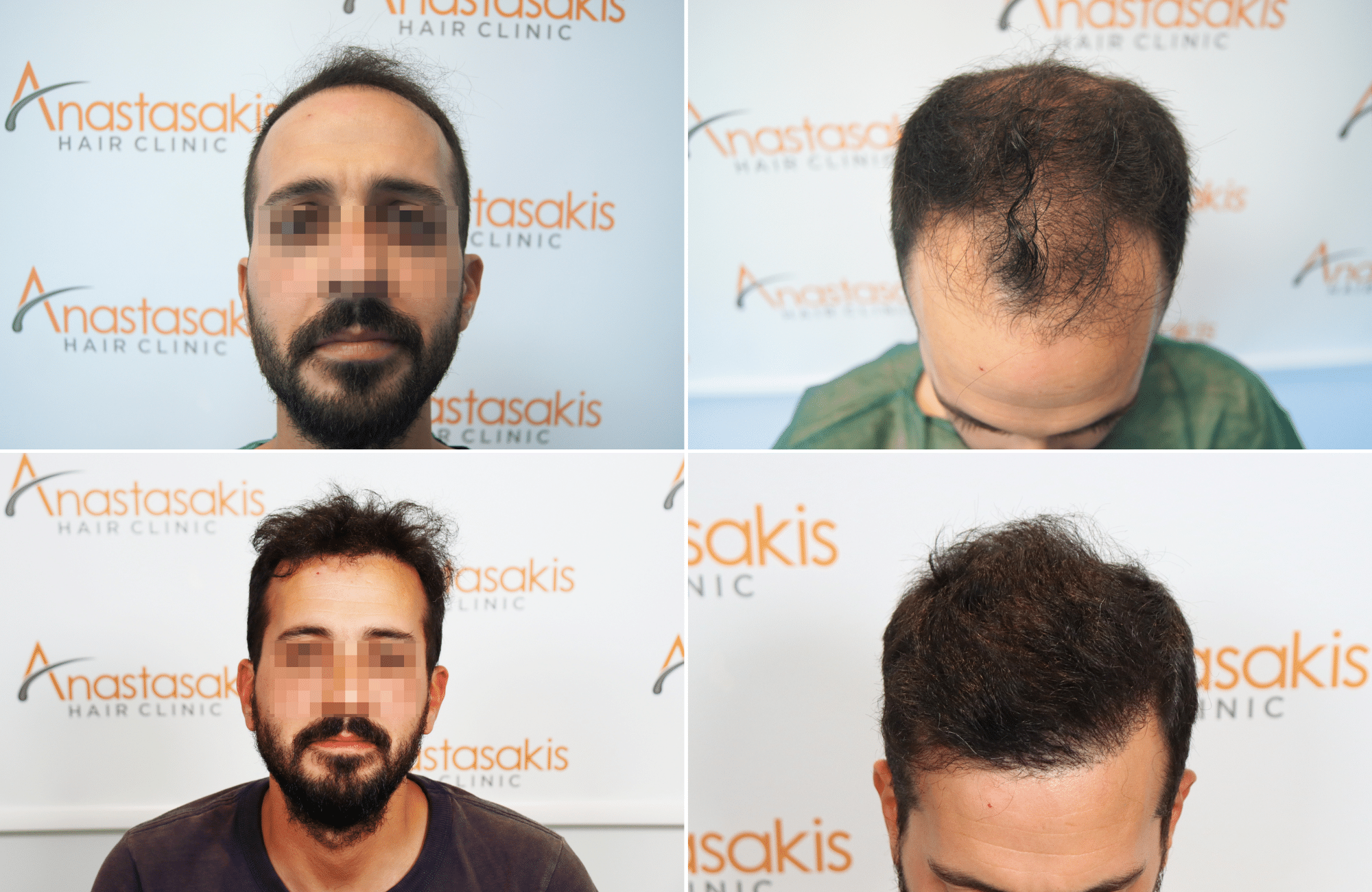 https://www.anastasakishairclinic.gr/portfolio/apotelesma-metamosxefsis-mallion-anastasakis-hair-clinic-506/