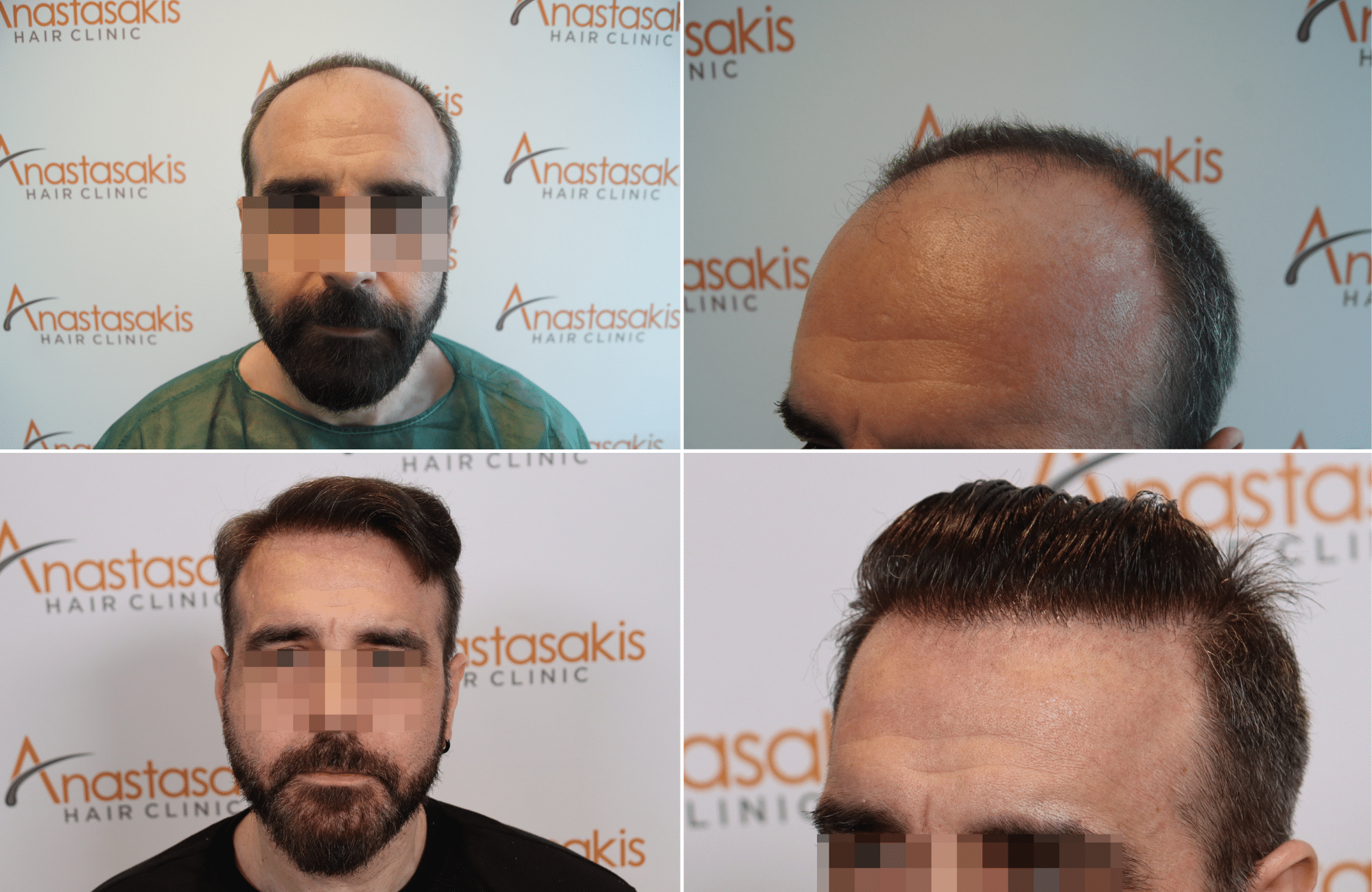 https://www.anastasakishairclinic.gr/portfolio/apotelesma-metamosxefsis-mallion-anastasakis-hair-clinic-505/