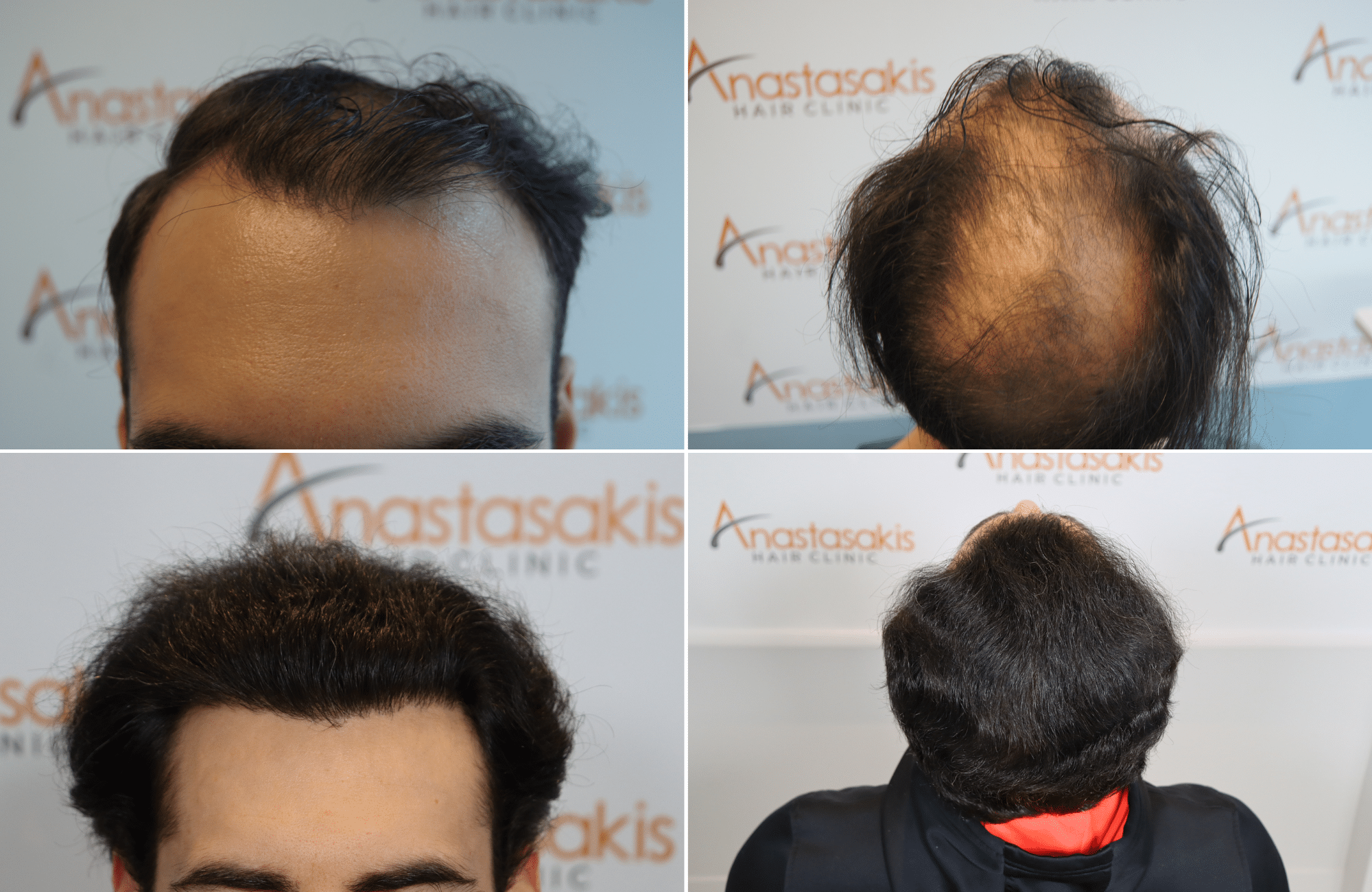 https://www.anastasakishairclinic.gr/portfolio/apotelesma-metamosxefsis-mallion-anastasakis-hair-clinic-509/