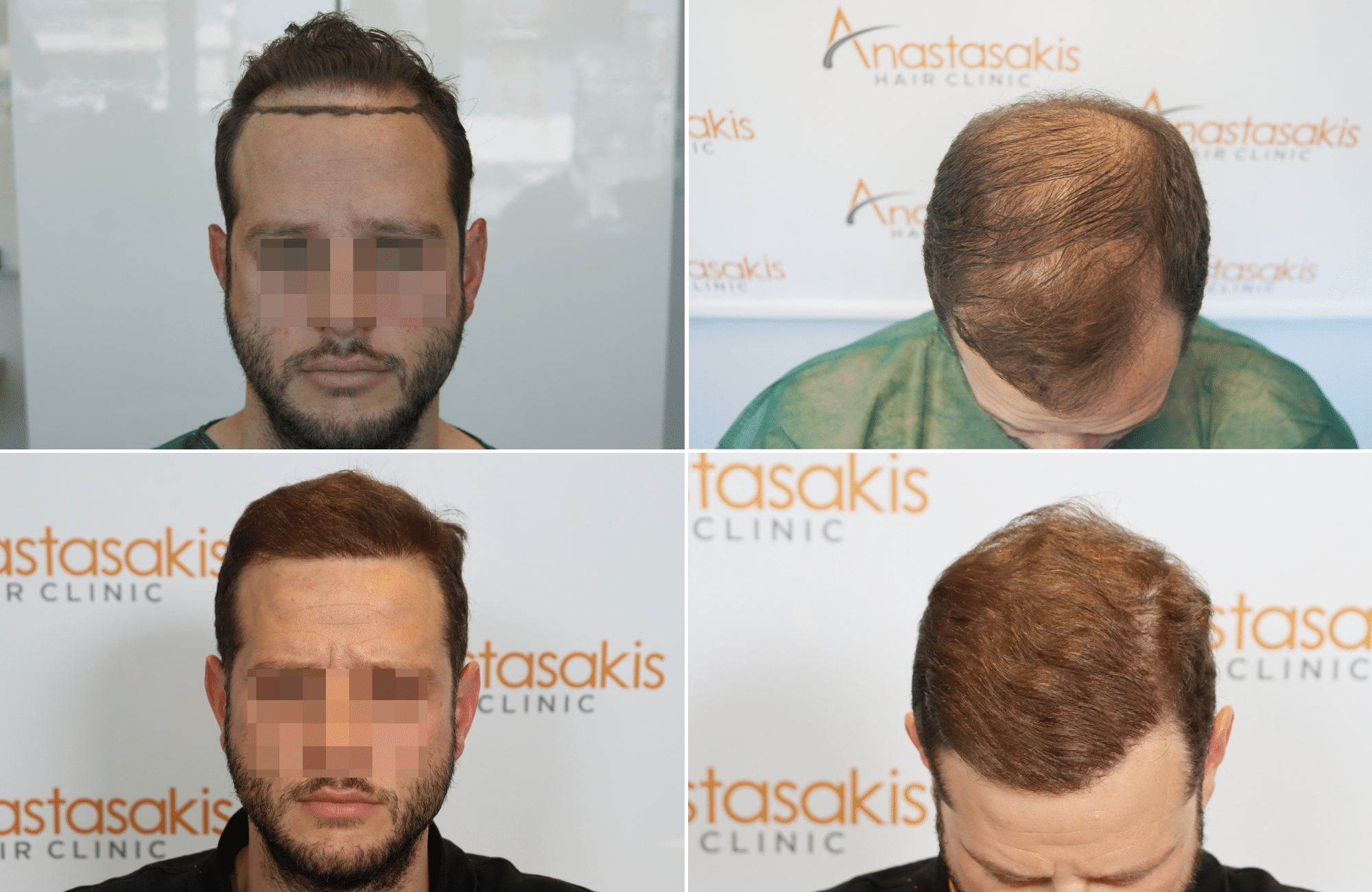 https://www.anastasakishairclinic.gr/portfolio/apotelesma-metamosxefsis-mallion-anastasakis-hair-clinic-499/