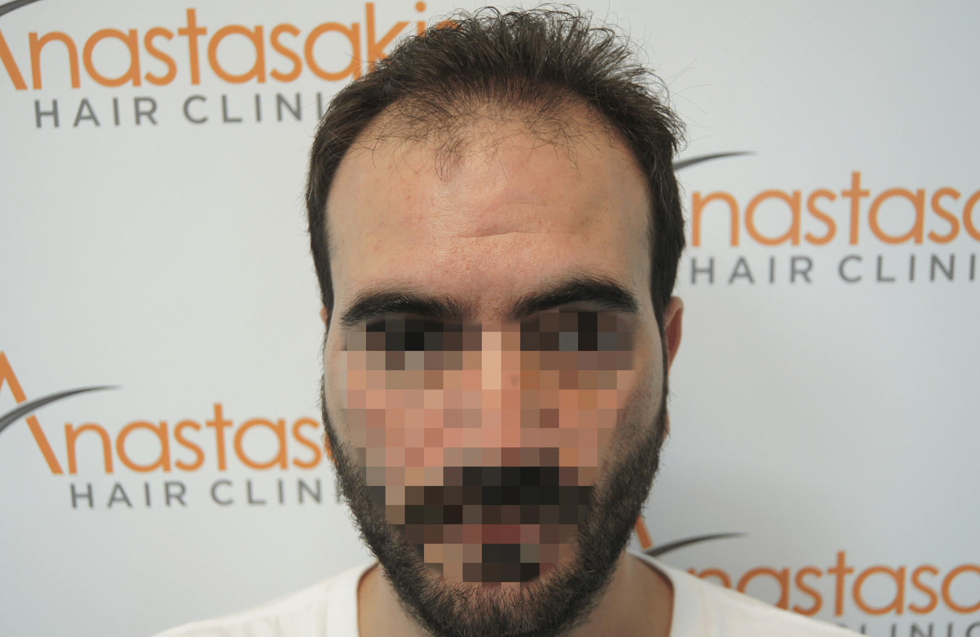 best hair transplant result with 3200 fus male fue anastasakis hair clinic