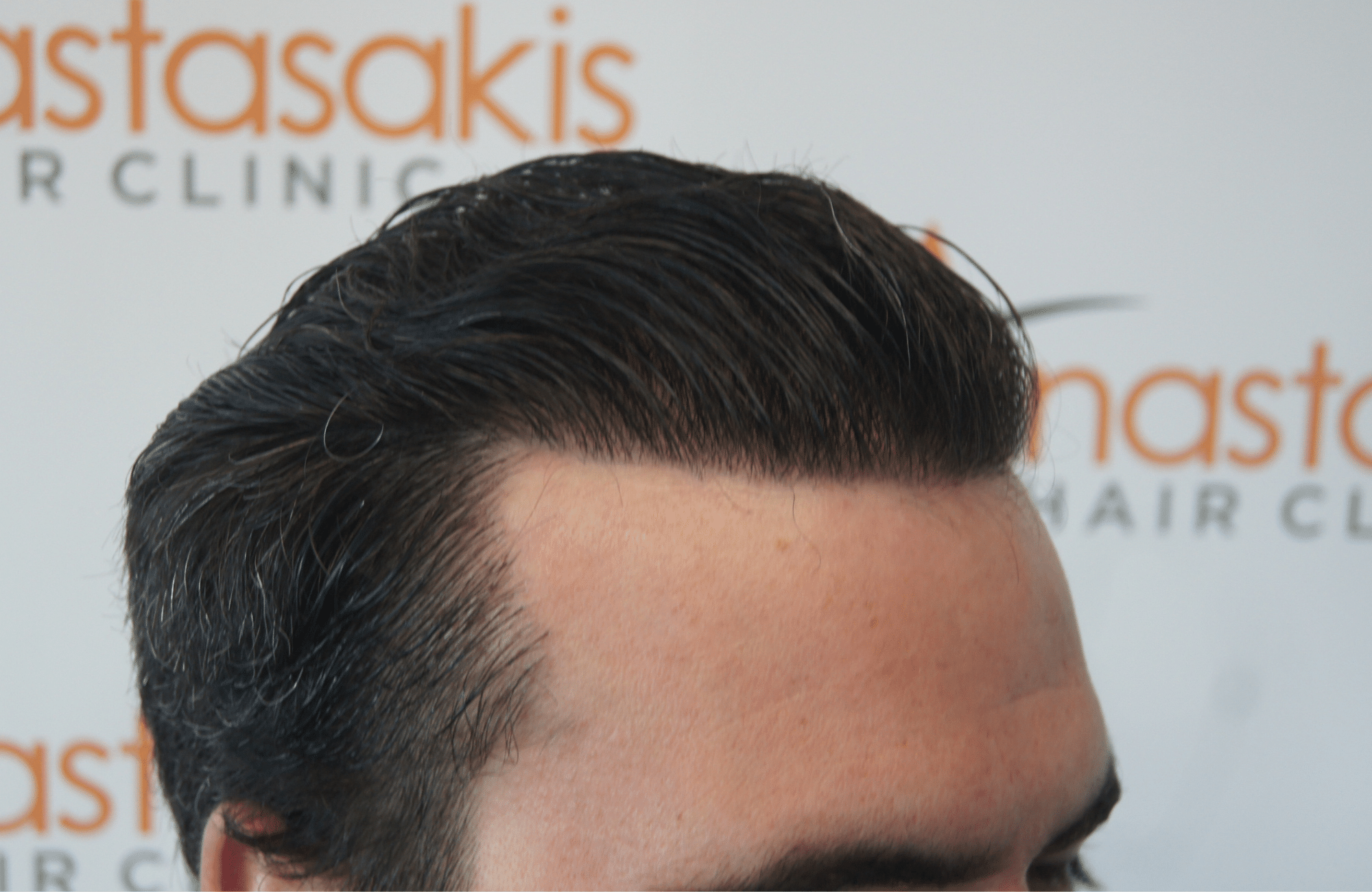 best hair transplant result with 3200 fus male fue anastasakis hair clinic