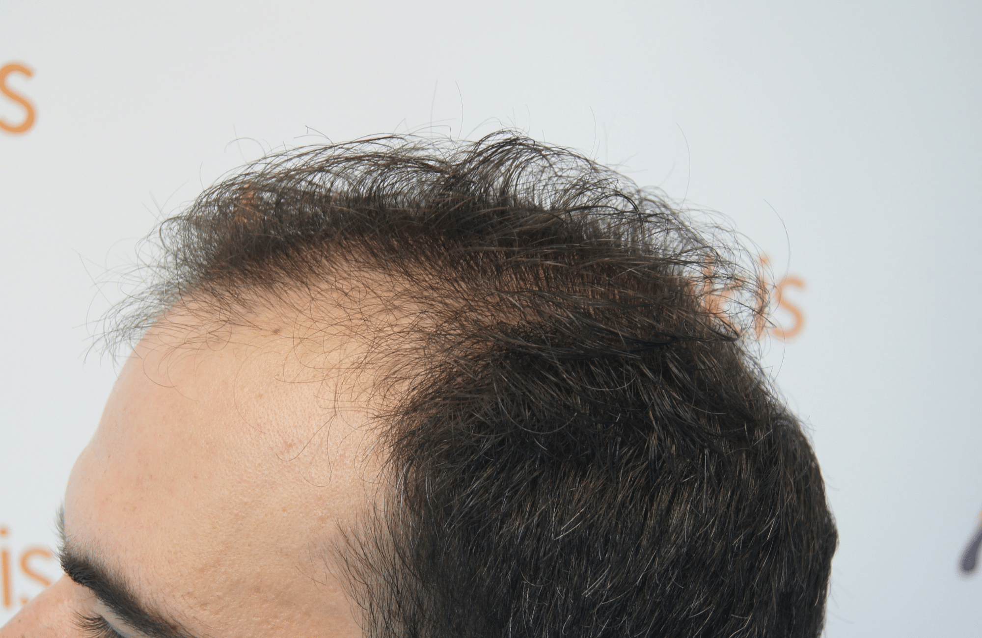 best hair transplant result with 3200 fus male fue anastasakis hair clinic