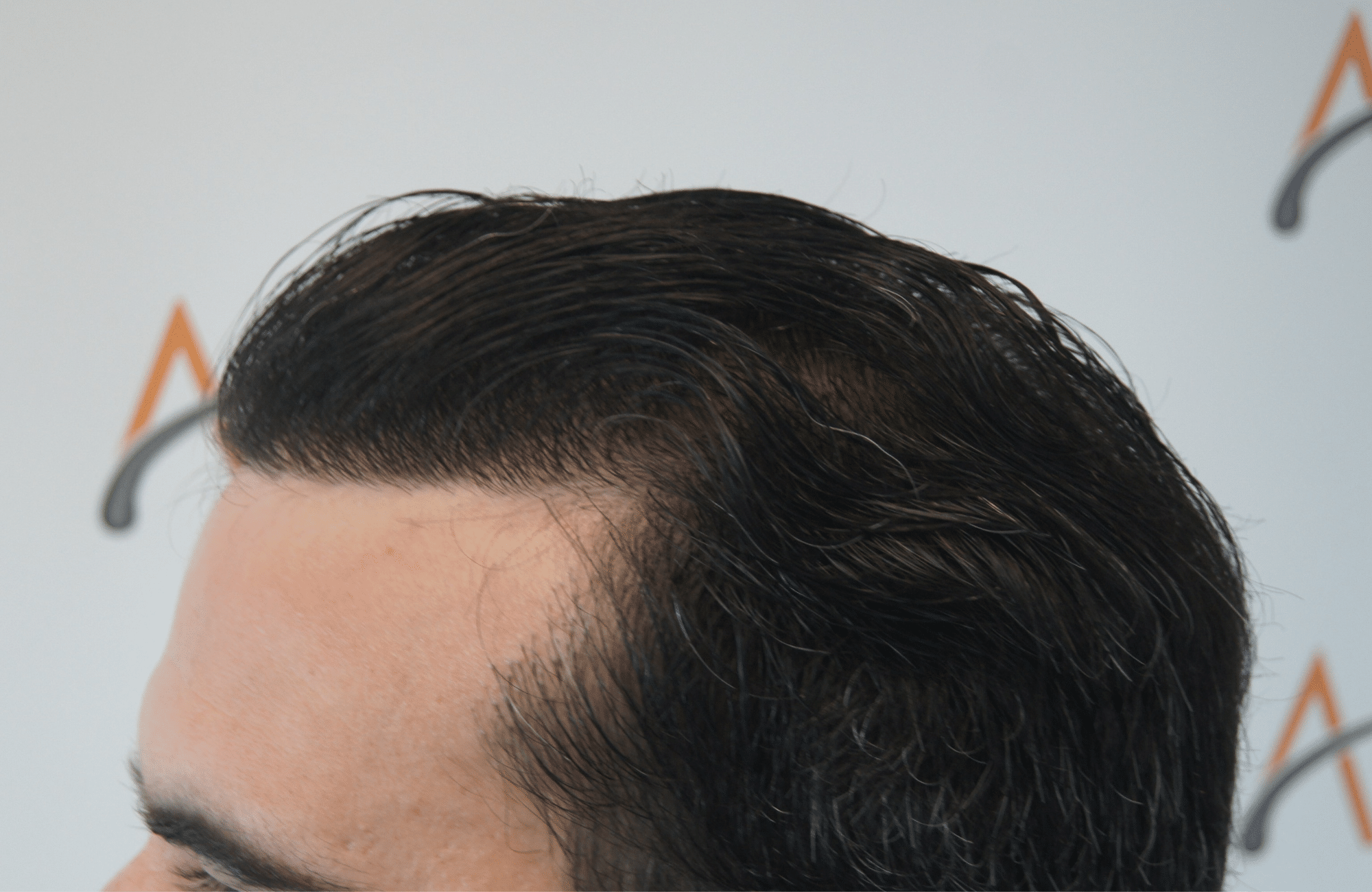 best hair transplant result with 3200 fus male fue anastasakis hair clinic