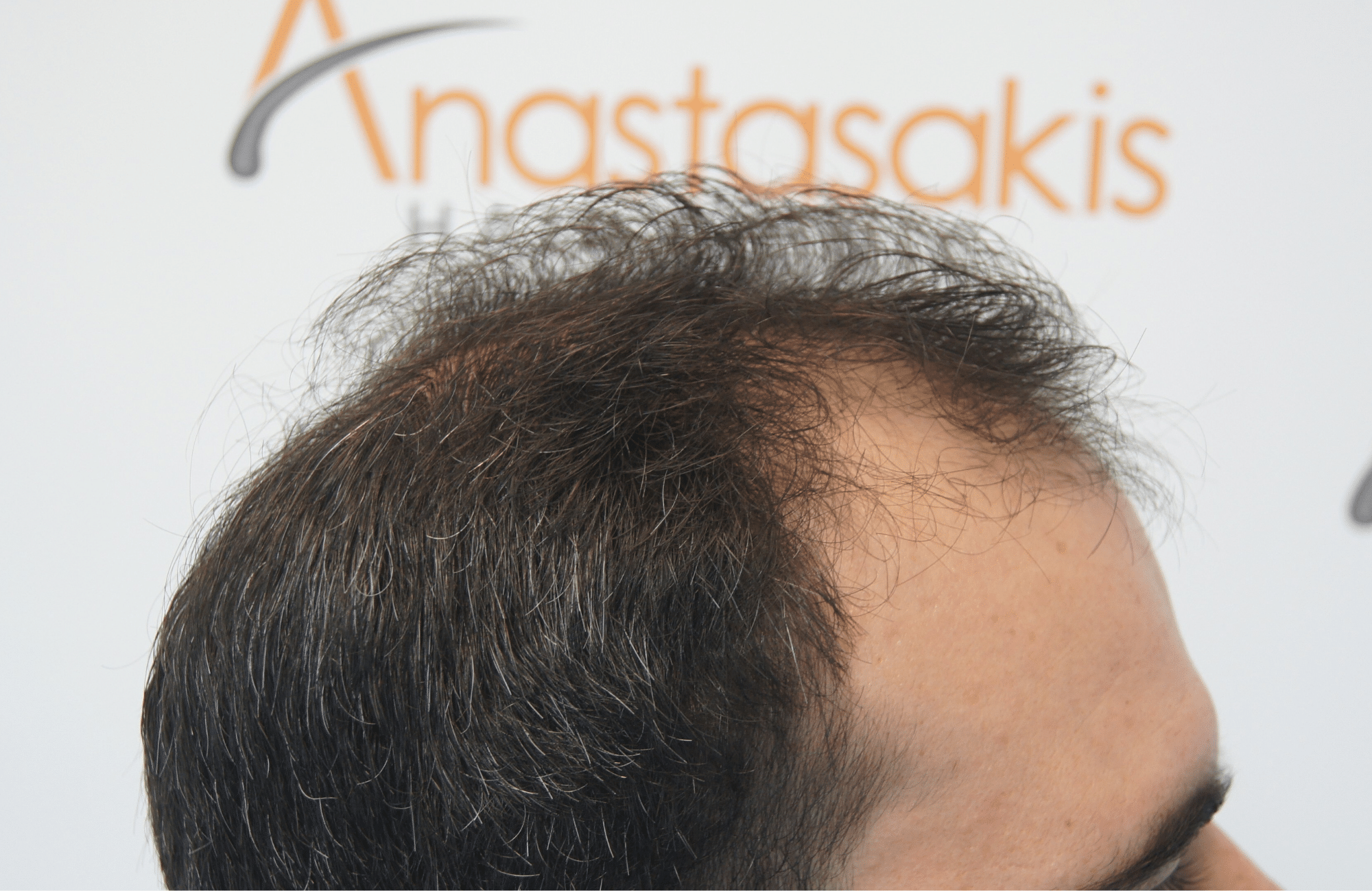 best hair transplant result with 3200 fus male fue anastasakis hair clinic