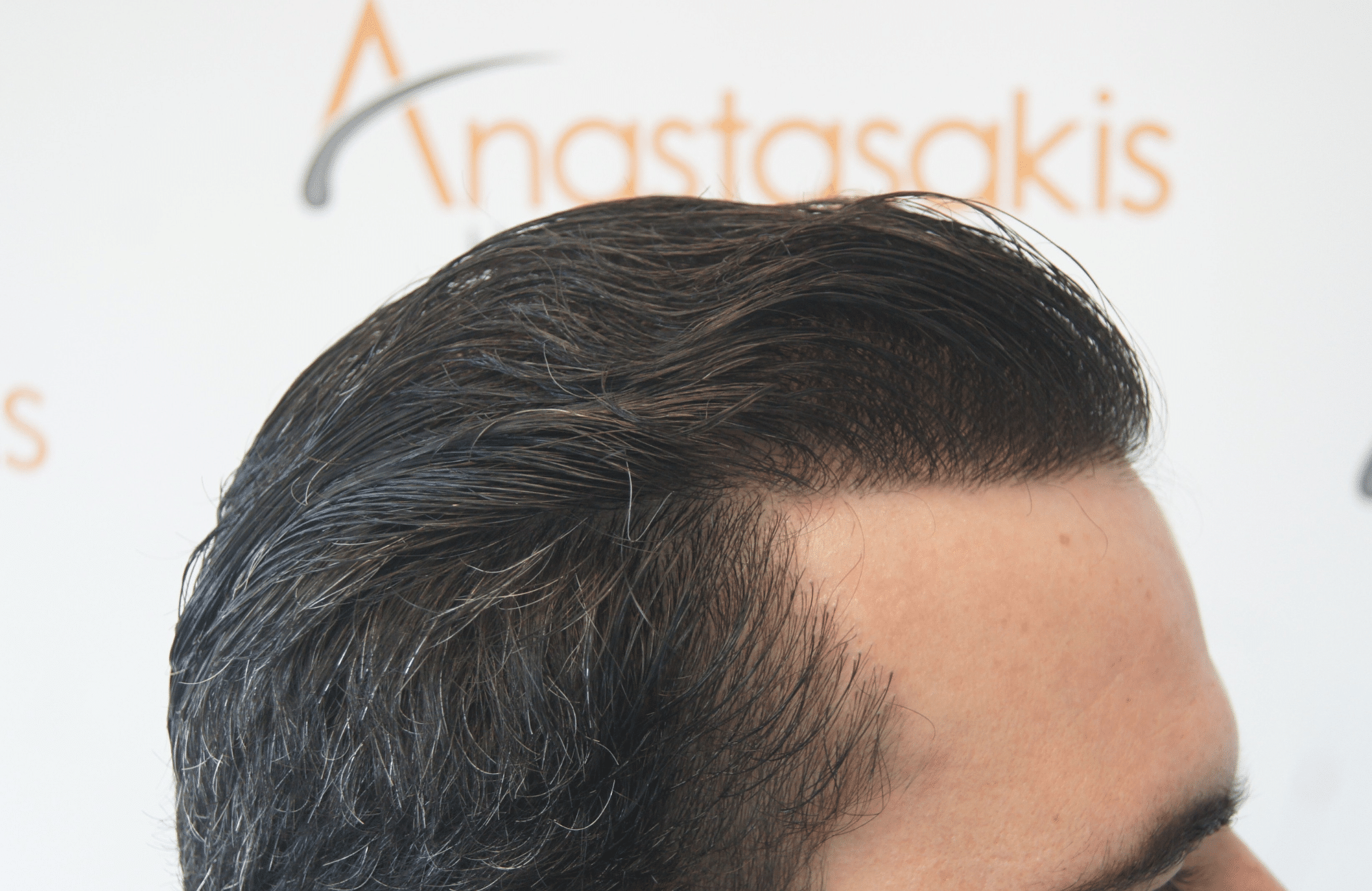 best hair transplant result with 3200 fus male fue anastasakis hair clinic