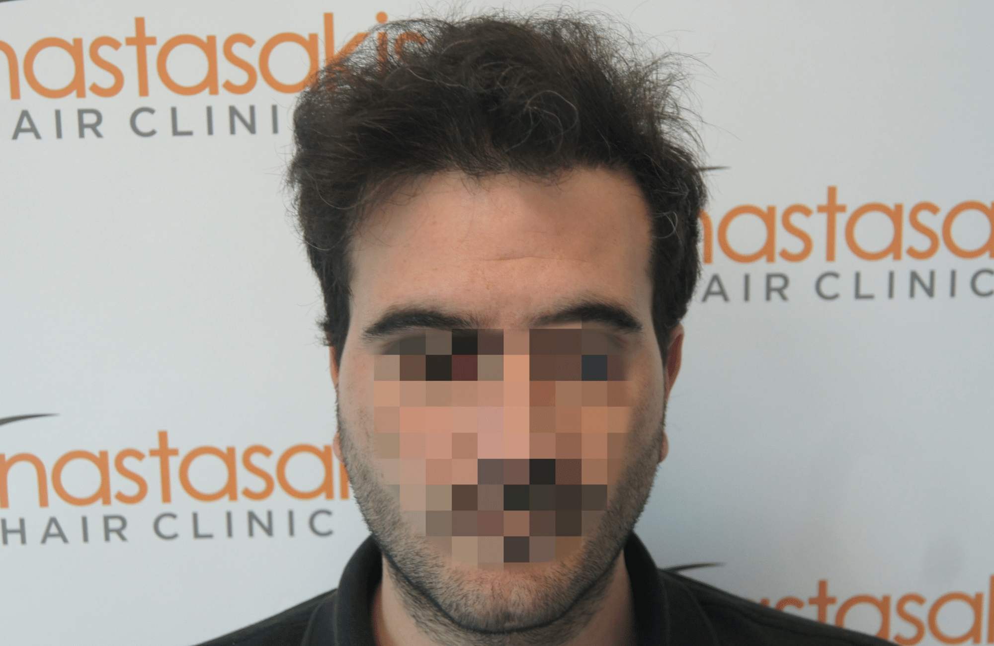 best hair transplant result with 3200 fus male fue anastasakis hair clinic