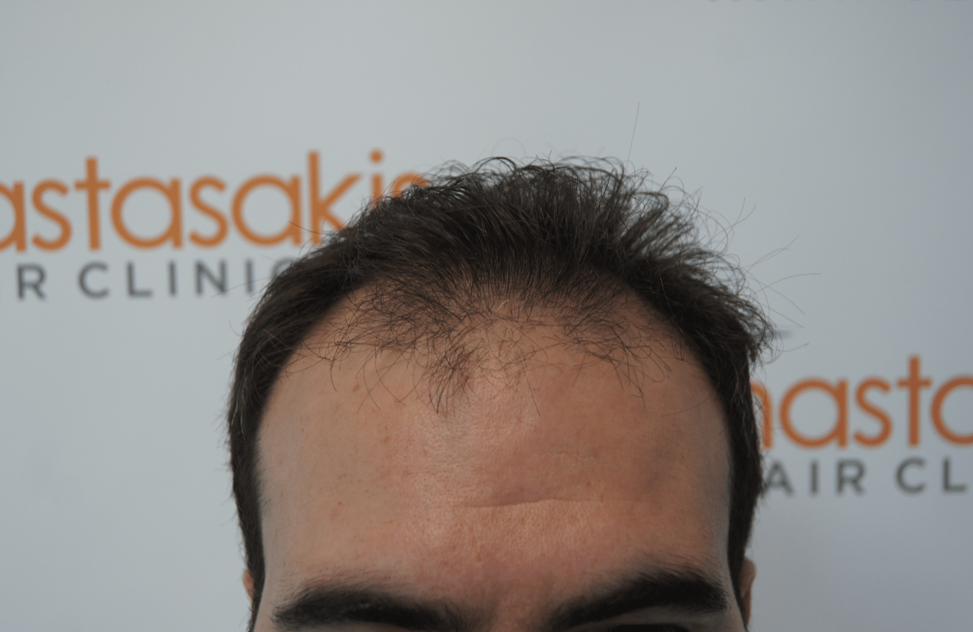 best hair transplant result with 3200 fus male fue anastasakis hair clinic