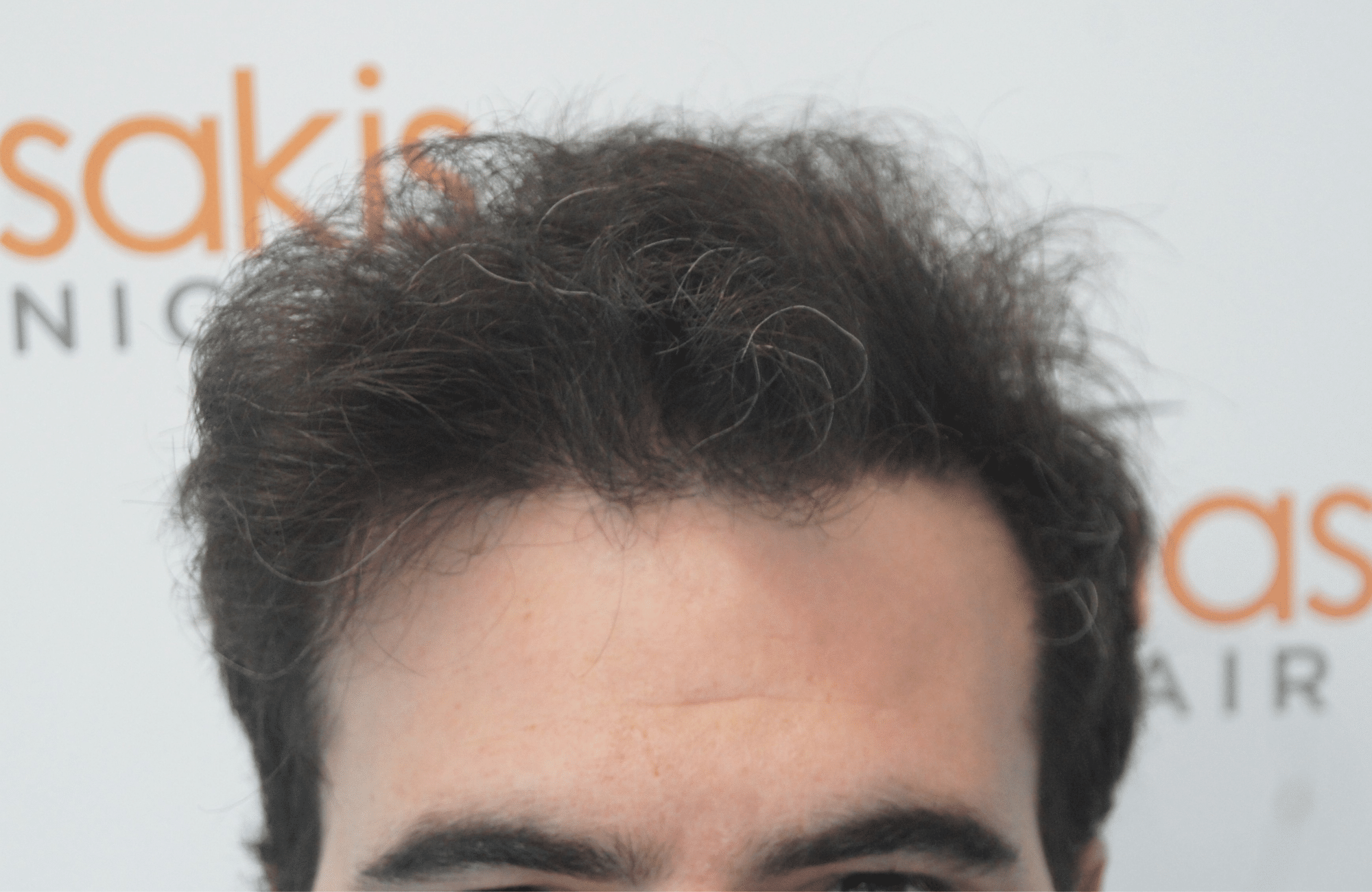 best hair transplant result with 3200 fus male fue anastasakis hair clinic