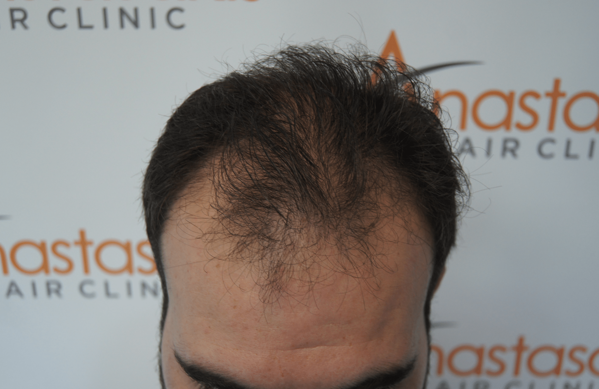 best hair transplant result with 3200 fus male fue anastasakis hair clinic