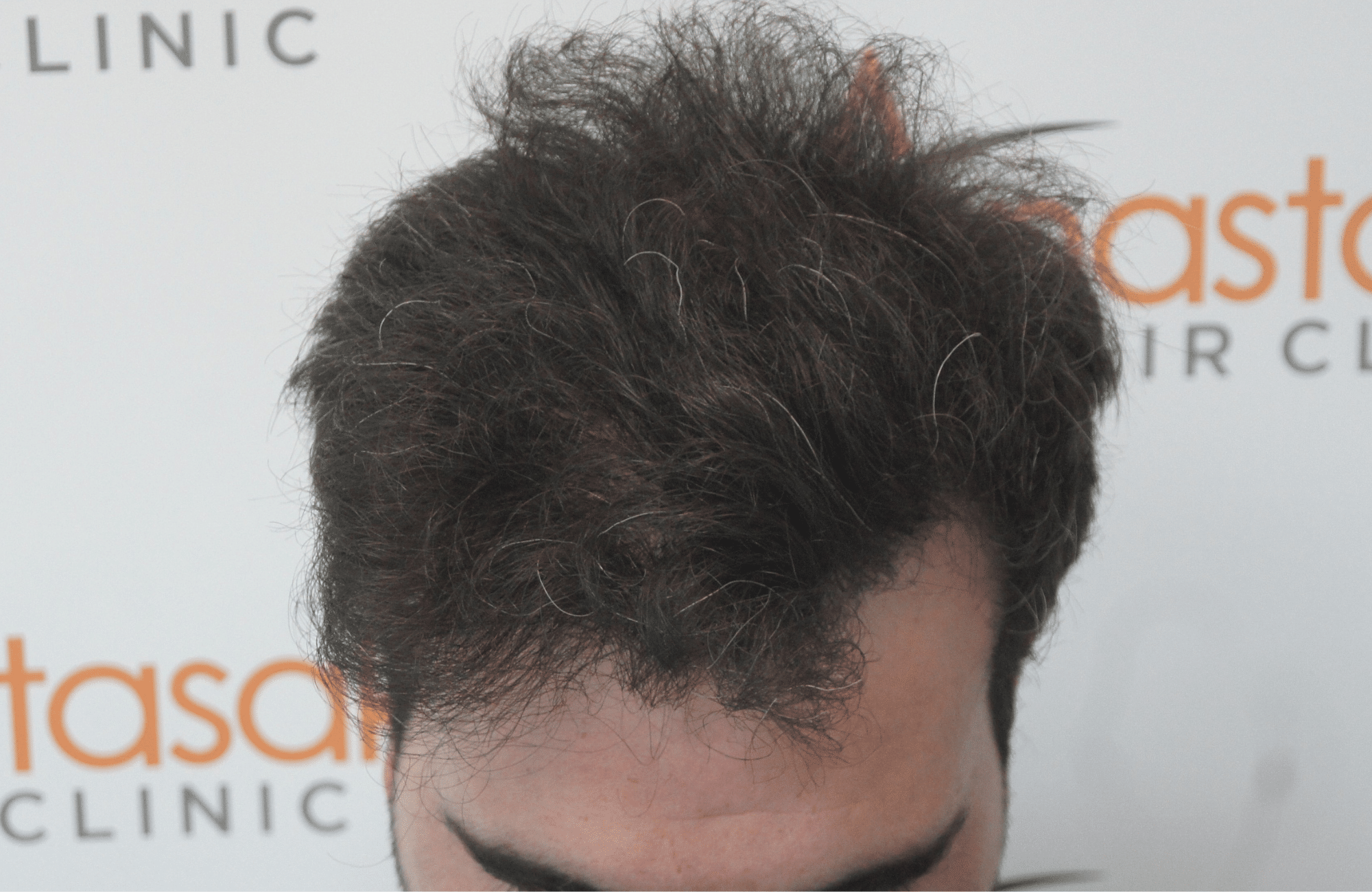 best hair transplant result with 3200 fus male fue anastasakis hair clinic