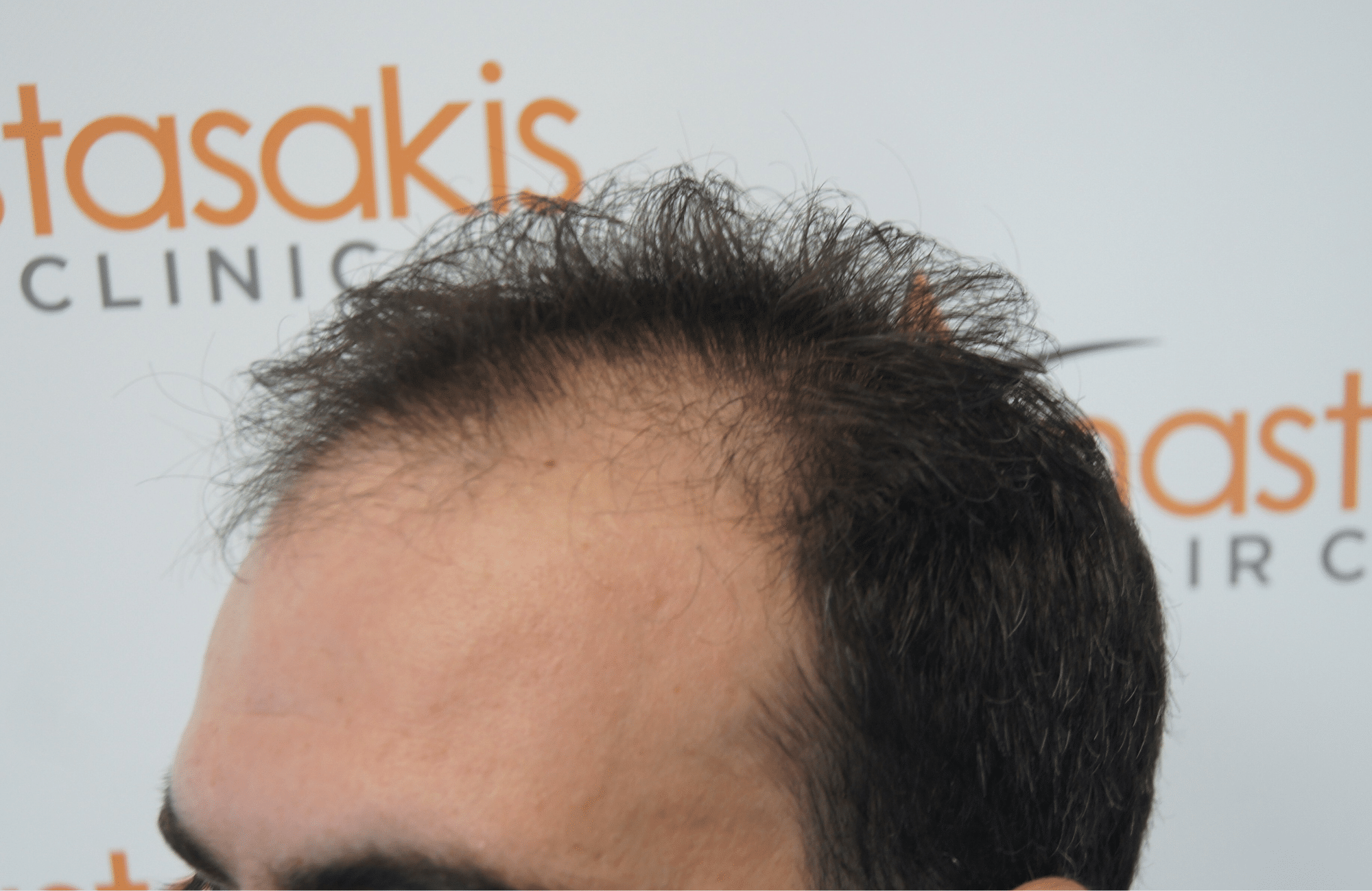 best hair transplant result with 3200 fus male fue anastasakis hair clinic