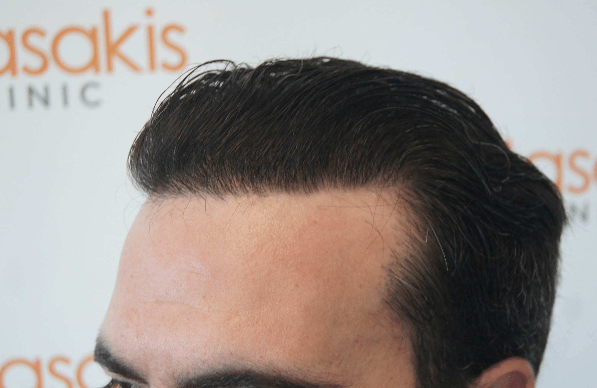 best hair transplant result with 3200 fus male fue anastasakis hair clinic