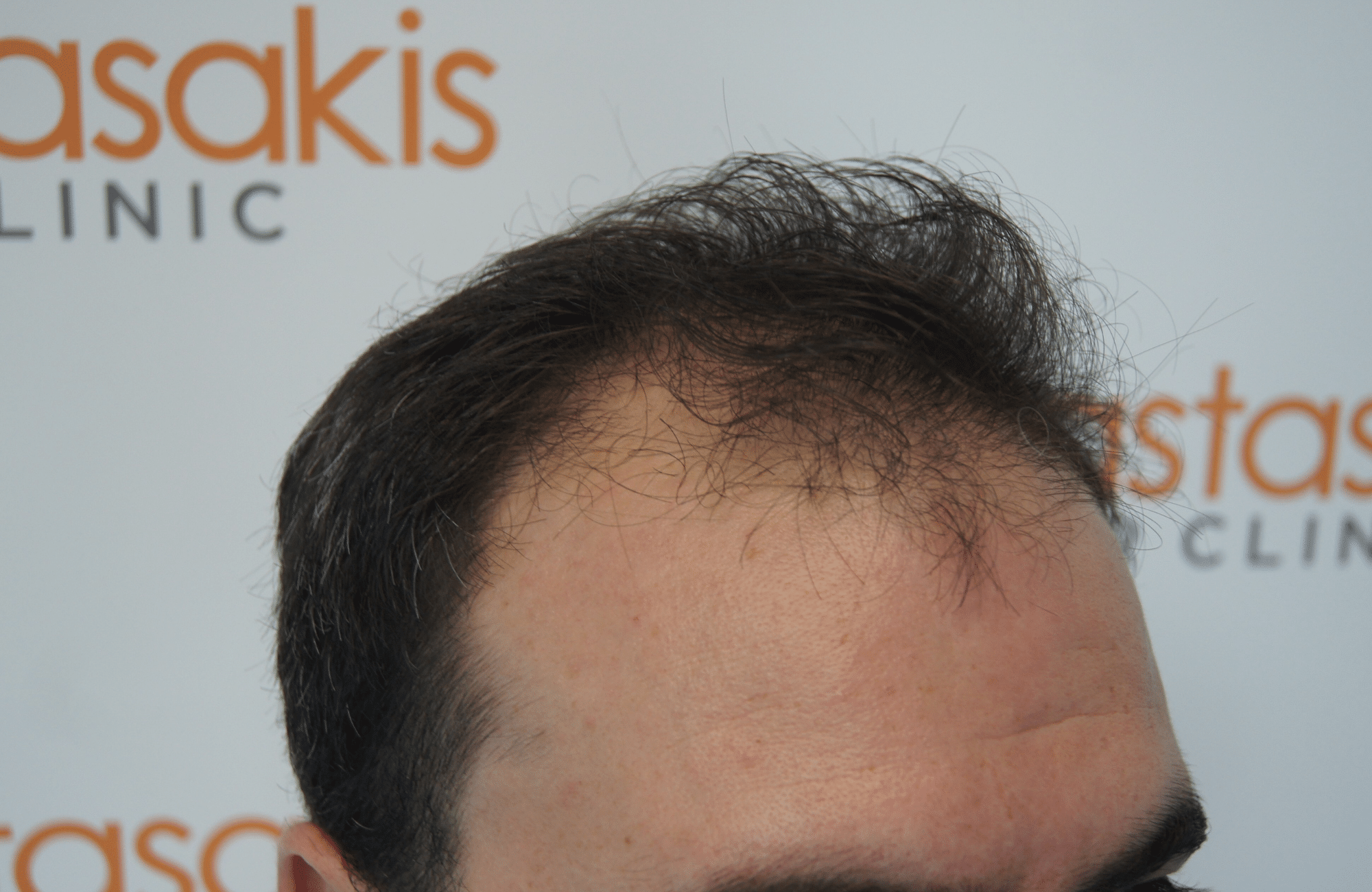 best hair transplant result with 3200 fus male fue anastasakis hair clinic