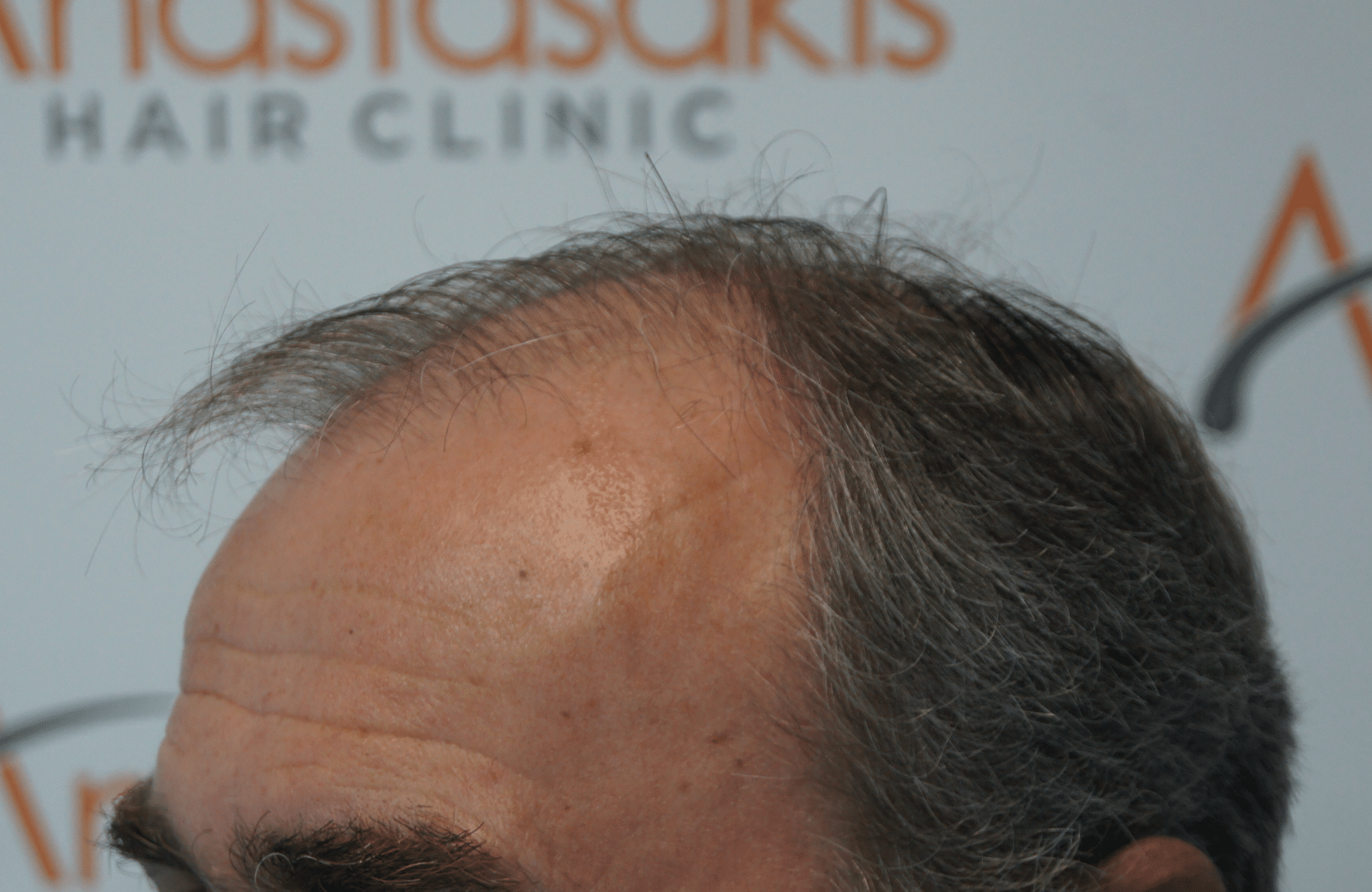 best hair transplant result with 3500 fus male fue anastasakis hair clinic