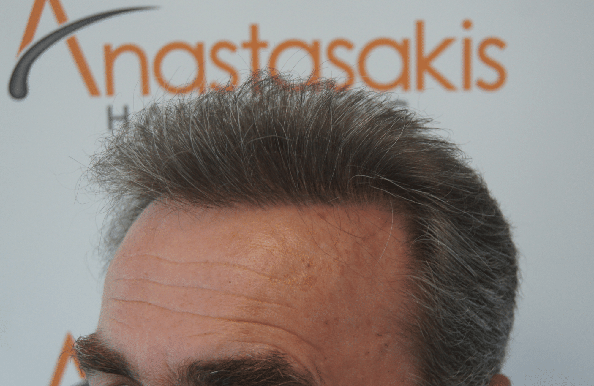 best hair transplant result with 3500 fus male fue anastasakis hair clinic