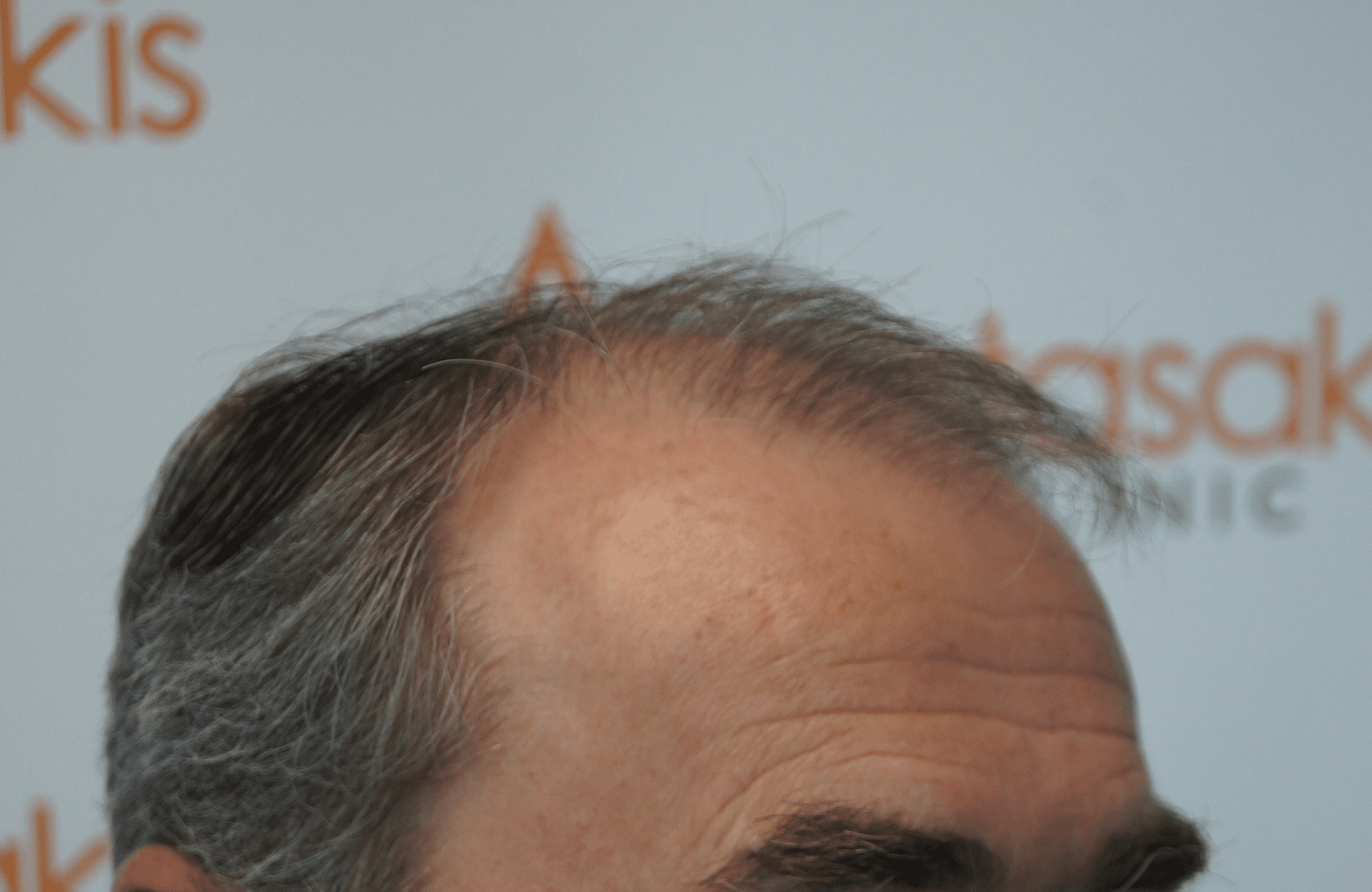 best hair transplant result with 3500 fus male fue anastasakis hair clinic