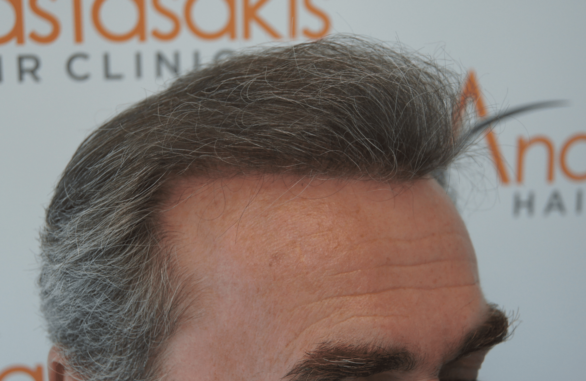 best hair transplant result with 3500 fus male fue anastasakis hair clinic
