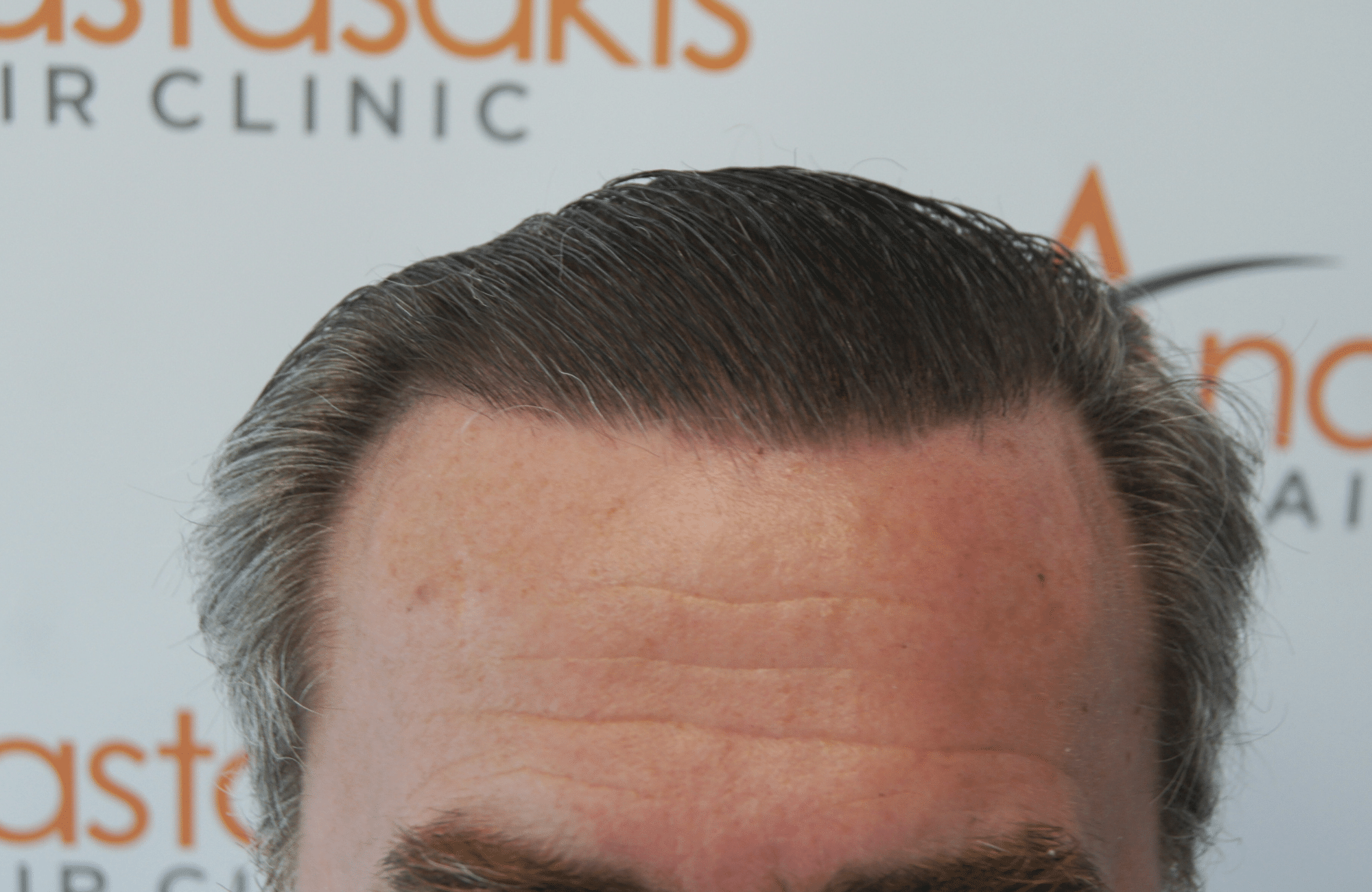 best hair transplant result with 3500 fus male fue anastasakis hair clinic
