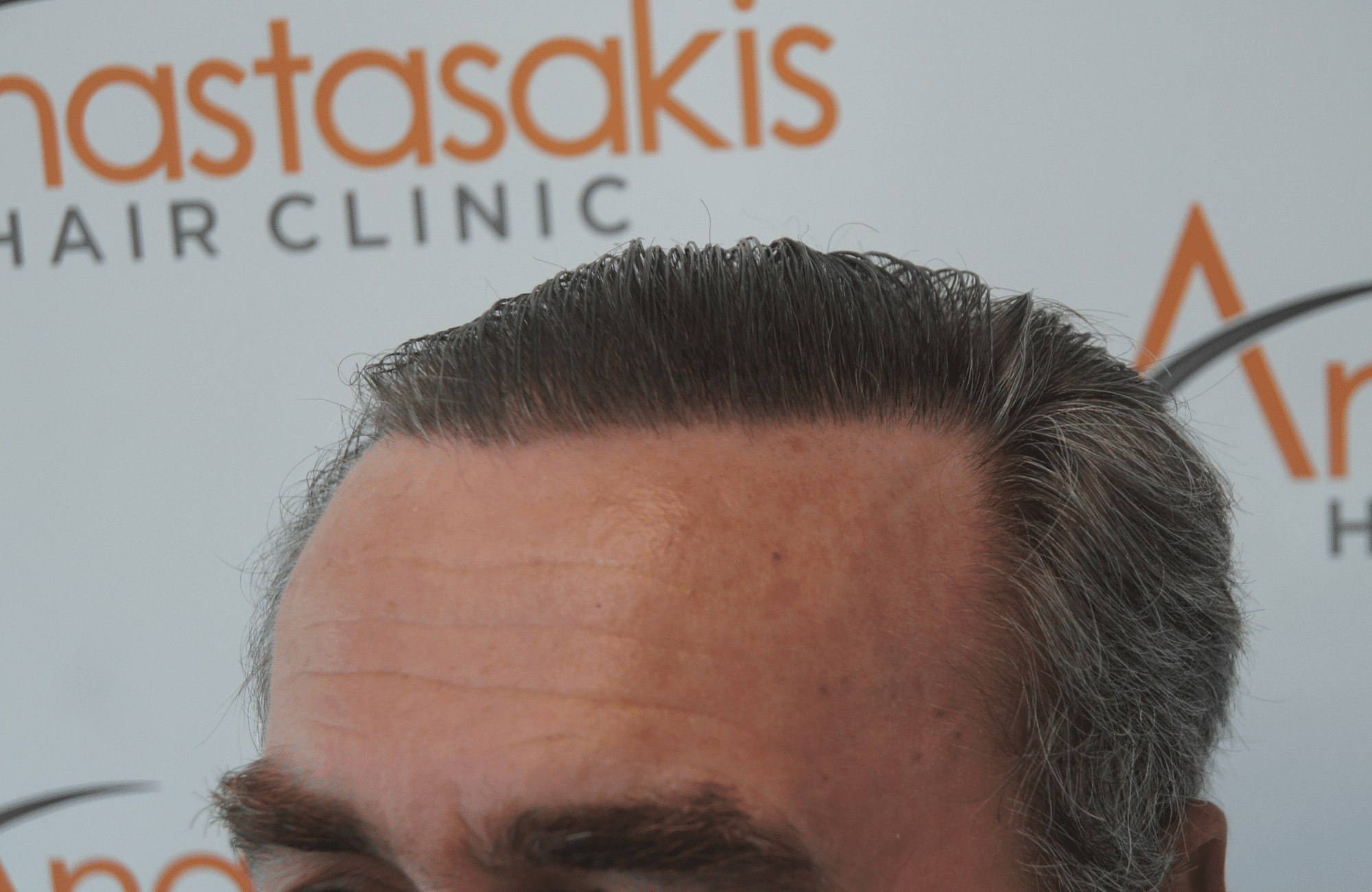 best hair transplant result with 3500 fus male fue anastasakis hair clinic
